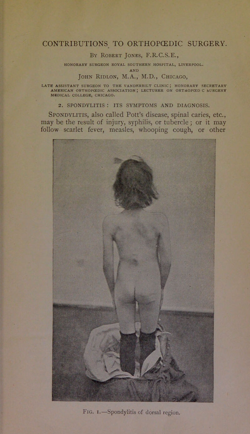 CONTRIBUTIONS TO ORTHOPCEDIC SURGERY. By Robert Jones, F.R.C.S.E., HONORARY SURGEON ROYAL SOUTHERN HOSPITAL, LIVERPOOL. AND John Ridlon, M.A., M.D., Chicago, LATE ASSISTANT SURGEON TO THE VANDERBILT CLINIC ; HONORARY SECRETARY AMERICAN ORTHOPCEDIC ASSOCIATION; LECTURER ON ORTHOPCED C SURGERY MEDICAL COLLEGE, CHICAGO. 2. SPONDYLITIS : ITS SYMPTOMS AND DIAGNOSIS. Spondylitis, also called Pott’s disease, spinal caries, etc., may be the result of injury, syphilis, or tubercle; or it may follow scarlet fever, measles, whooping cough, or other Fig. I.—Spondylitis of dorsal region.