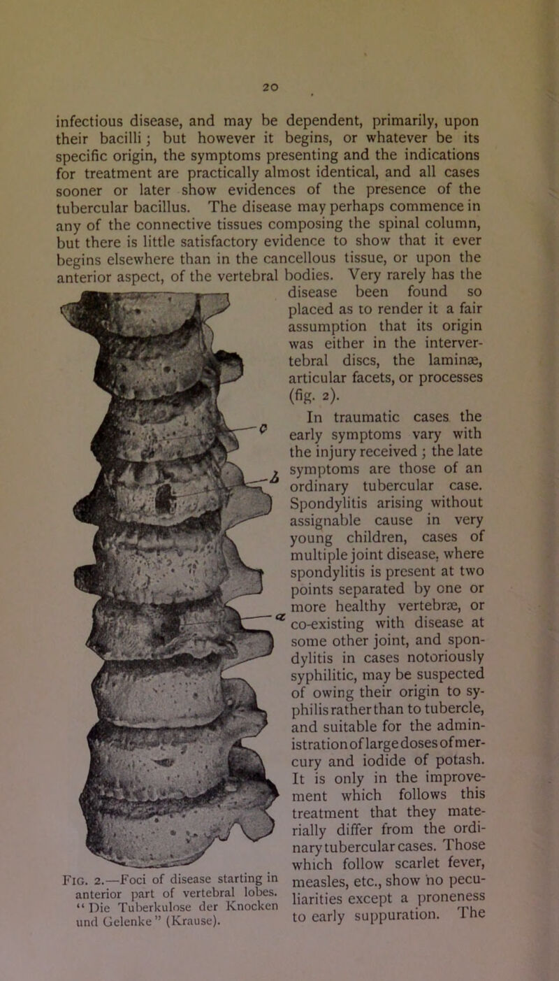 infectious disease, and may be dependent, primarily, upon their bacilli; but however it begins, or whatever be its specific origin, the symptoms presenting and the indications for treatment are practically almost identical, and all cases sooner or later show evidences of the presence of the tubercular bacillus. The disease may perhaps commence in any of the connective tissues composing the spinal column, but there is little satisfactory evidence to show that it ever begins elsewhere than in the cancellous tissue, or upon the anterior aspect, of the vertebral bodies. Very rarely has the disease been found so Fig. 2.—Foci of disease starting in anterior part of vertebral lobes. “ Die Tuberkulose tier Knocken und Gelenke” (Krause). placed as to render it a fair assumption that its origin was either in the interver- tebral discs, the laminae, articular facets, or processes (fig. 2). In traumatic cases the early symptoms vary with the injury received ; the late symptoms are those of an ordinary tubercular case. Spondylitis arising without assignable cause in very young children, cases of multiple joint disease, where spondylitis is present at two points separated by one or more healthy vertebrae, or co-existing with disease at some other joint, and spon- dylitis in cases notoriously syphilitic, may be suspected of owing their origin to sy- philis rather than to tubercle, and suitable for the admin- istration of large doses of mer- cury and iodide of potash. It is only in the improve- ment which follows this treatment that they mate- rially differ from the ordi- nary tubercular cases. Those which follow scarlet fever, measles, etc., show no pecu- liarities except a jironeness to early suppuration. The