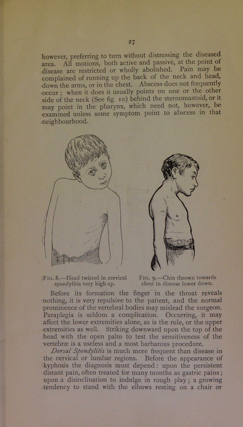 however, preferring to turn without distressing the diseased area. All motions, both active and passive, at the point of • disease are restricted or wholly abolished. Pain may be complained of running up the back of the neck and head, down the arms, or in the chest. Abscess does not frequently -occur; when it does it usually points on one or the other sidq of the neck (See fig. lo) behind the sternomastoid, or it may point in the pharynx, which need not, however, be examined unless some symptom point to abscess in that •neighbourhood. iFig. 8.—Head twisted in cervical Fig. 9.—Chin thrown towards Before its formation the finger in the throat reveals •nothing, it is very repulsive to the patient, and the normal prominence of the vertebral bodies may mislead the surgeon. Paraplegia is seldom a complication. Occurring, it may affect the lower extremities alone, as is the rule, or the upper extremities as well. Striking downward upon the top of the head with the open palm to test the sensitiveness of the vertebrae is a useless and a most barbarous procedure. Dorsal Spondylitis is much more frequent than disease in the cervical or lumbar regions. Before the appearance of 'kyphosis the diagnosis must depend; upon the persistent distant pain, often treated for many months as gastric pains; upon a disinclination to indulge in rough play; a growing •tendency to stand with the elbows resting on a chair or spondylitis very high up. chest in disease lower down.