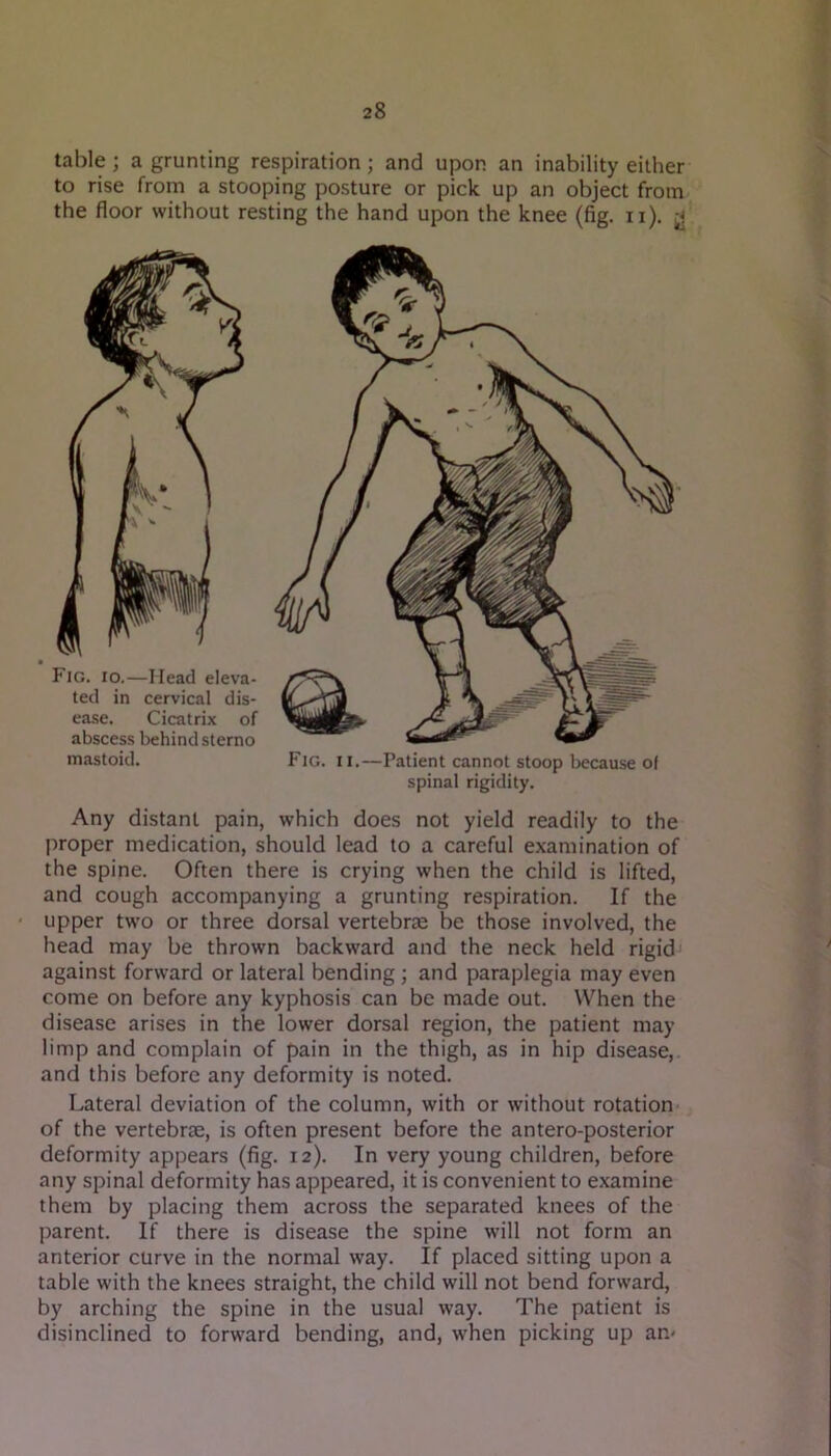 table; a grunting respiration; and upon an inability either to rise from a stooping posture or pick up an object from the floor without resting the hand upon the knee (fig, ii). ^ Any distant pain, which does not yield readily to the proper medication, should lead to a careful examination of the spine. Often there is crying when the child is lifted, and cough accompanying a grunting respiration. If the upper two or three dorsal vertebrae be those involved, the head may be thrown backward and the neck held rigid' against forward or lateral bending; and paraplegia may even come on before any kyphosis can be made out. When the disease arises in the lower dorsal region, the patient may limp and complain of pain in the thigh, as in hip disease,, and this before any deformity is noted. Lateral deviation of the column, with or without rotation of the vertebrae, is often present before the antero-posterior deformity appears (fig. 12). In very young children, before any spinal deformity has appeared, it is convenient to examine them by placing them across the separated knees of the parent. If there is disease the spine will not form an anterior curve in the normal way. If placed sitting upon a table with the knees straight, the child will not bend forward, by arching the spine in the usual way. The patient is disinclined to forward bending, and, when picking up an- Fig. II.—Patient cannot stoop because ol spinal rigidity.