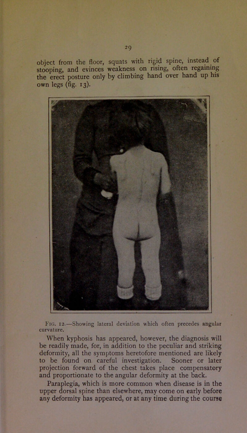 object from the floor, squats with rigid spine, instead of stooping, and evinces weakness on rising, often regaining the erect posture only by climbing hand over hand up his own legs (fig. 13). Fig. 12.—Showing lateral deviation which often precedes angular curvature. When kyphosis has appeared, however, the diagnosis will be readily made, for, in addition to the peculiar and striking deformity, all the symptoms heretofore mentioned are likely to be found on careful investigation. Sooner or later projection forward of the chest takes place compensatory and proportionate to the angular deformity at the back. Paraplegia, which is more common when disease is in the upper dorsal spine than elsewhere, may come on early before any deformity has appeared, or at any time during the course