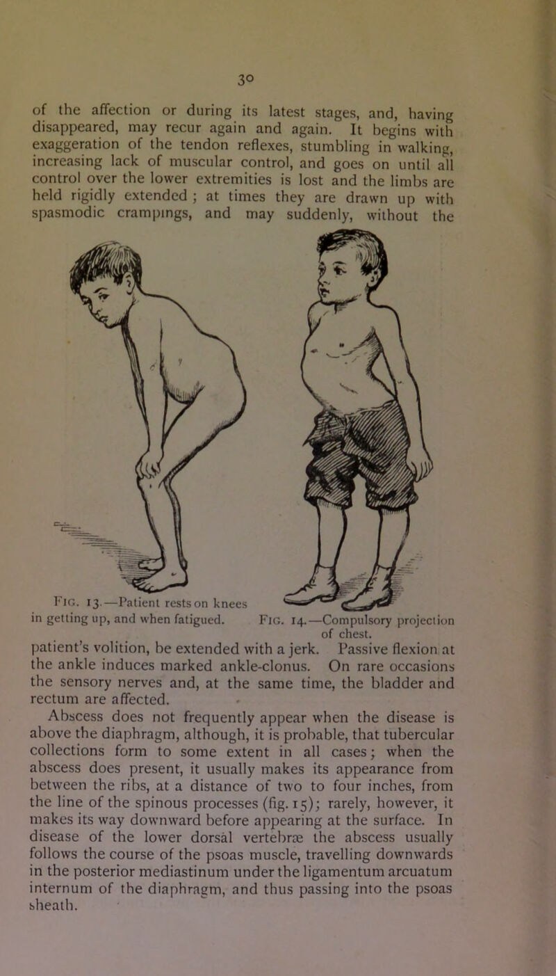 of the affection or during its latest stages, and, having disappeared, may recur again and again. It begins with exaggeration of the tendon reflexes, stumbling in walking, increasing lack of muscular control, and goes on until all control over the lower extremities is lost and the limbs are held rigidly extended ; at times they are drawn up with spasmodic crampmgs, and may suddenly, without the Fig. 13.—Patient rests on knees in getting up, and when fatigued. Fig. 14.—Compulsory jirojeclion of chest. patient’s volition, be extended with a jerk. Passive flexion at the ankle induces marked ankle-clonus. On rare occasions the sensory nerves and, at the same time, the bladder and rectum are affected. Abscess does not frequently appear when the disease is above the diaphragm, although, it is probable, that tubercular collections form to some extent in all cases; when the abscess does present, it usually makes its appearance from between the ribs, at a distance of two to four inches, from the line of the spinous processes (fig. 15); rarely, however, it makes its way downward before appearing at the surface. In disease of the lower dorsal vertebrae the abscess usually follows the course of the psoas muscle, travelling downwards in the posterior mediastinum under the ligamentum arcuatum internum of the diaphragm, and thus passing into the psoas bheath.