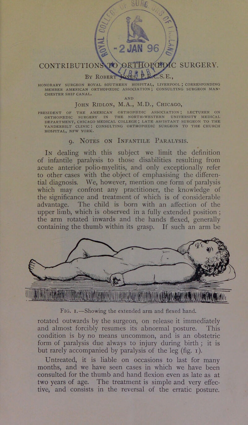 HONORARY SURGEON ROYAL SOUTHERN HOSPITAI,, LIVERPOOL ; CORRESPONDING MEMBER AMERICAN ORTHOPtEDIC ASSOCIATION ; CONSULTING SURGEON MAN- CHESTER SHIP CANAL. AND John Ridlon, M.A., M.D., Chicago, PRESIDENT OF THE AMERICAN ORTHOPIEDIC ASSOCIATION ; LECTURER ON ORTHOPCEDIC SURGERY IN THE NORTH-WESTERN UNIVERSITY MEDICAL DEPARTMENT, CHICAGO MEDICAL COLLEGE ; LATE ASSISTANT SURGEON TO THE VANDERBILT CLINIC I CONSULTING ORTHOPCEDIC SURGEON TO THE CHURCH HOSPITAL, NFW YORK. 9. Notes on Infantile Paralysis. In dealing with this subject we limit the definition of infantile paralysis to those disabilities resulting from acute anterior polio-myelitis, and only exceptionally refer to other cases with the object of emphasising the differen- tial diagnosis. We, however, mention one form of paralysis which may confront any practitioner, the knowledge of the significance and treatment of which is of considerable advantage. The child is born with an affection of the upper limb, which is observed in a fully extended position ; the arm rotated inwards and the hands flexed, generally containing the thumb within its grasp. If such an arm be Fig. I.—Showing the e.xtended arm and flexed hand. rotated outwards by the surgeon, on release it immediately and almost forcibly resumes its abnormal posture. This condition is by no means uncommon, and is an obstetric form of paralysis due always to injury during birth; it is but rarely accompanied by paralysis of the leg (fig. i). Untreated, it is liable on occasions to last for many months, and we have seen cases in which we have been consulted for the thumb and hand flexion even as late as at two years of age. The treatment is simple and very effec- tive, and consists in the reversal of the erratic posture.