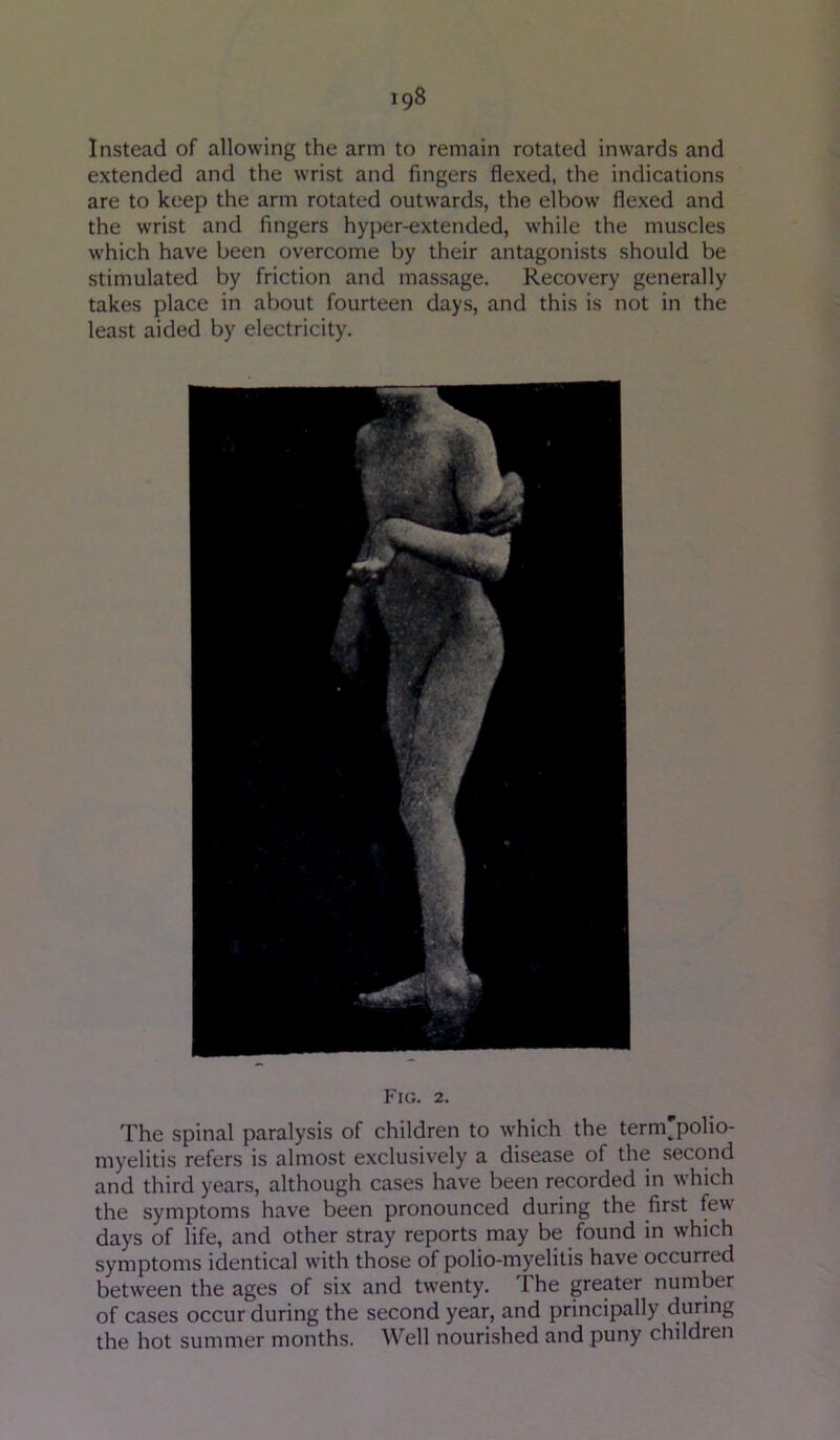 Instead of allowing the arm to remain rotated inwards and extended and the wrist and fingers flexed, the indications are to keep the arm rotated outwards, the elbow flexed and the wrist and fingers hyper-extended, while the muscles which have been overcome by their antagonists should be stimulated by friction and massage. Recovery generally takes place in about fourteen days, and this is not in the least aided by electricity. Fig. 2. The spinal paralysis of children to which the term'polio- myelitis refers is almost exclusively a disease of the second and third years, although cases have been recorded in which the symptoms have been pronounced during the first few days of life, and other stray reports may be found in which symptoms identical with those of polio-myelitis have occurred between the ages of six and twenty. The greater number of cases occur during the second year, and principally during the hot summer months. Well nourished and puny children