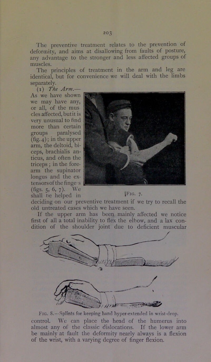 1’he preventive treatment relates to the prevention of deformity, and aims at disallowing from faults of posture, any advantage to the stronger and less affected groups of muscles. The principles of treatment in the arm and leg are identical, but for convenience we will deal with the limbs separately. (i) The Arm.— As we have shown we may have any, or all, of the mus cles affected, butit is very unusual to find more than certain groups paralysed (fig. 4); in the upper arm, the deltoid, bi- ceps, brachialis an- ticus, and often the triceps; in the fore- arm the supinator longus and the ex- tensors of the fi nge • s (figs. 5, 6, 7). We shall he helped in i*'**’’- 7- deciding on our preventive treatment if we try to recall the old untreated cases which we have seen. If the upper arm has been mainly affected we notice first of all a total inability to flex the el how, and a lax con- dition of the shoulder joint due to deficient muscular Fig. 8.—Splints for keeping hand hyper-extended in wrist-drop, control. We can place the head of the humerus into almost any of the classic dislocations. If the lower arm be mainly at fault the deformity nearly always is a flexion of the wrist, with a varying degree of finger flexion.