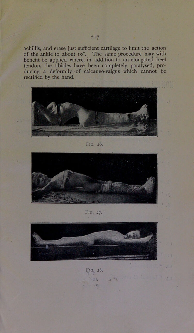 achillis, and erase just sufficient cartilage to limit the action of the ankle to about io°. The same procedure may with benefit be applied where, in addition to an elongated heel tendon, the tibiales have been completely paralysed, pro- ducing a deformily of calcaneo-valgus which cannot be rectified by the hand. Fm. 28. i '-t.i. ^ •*!