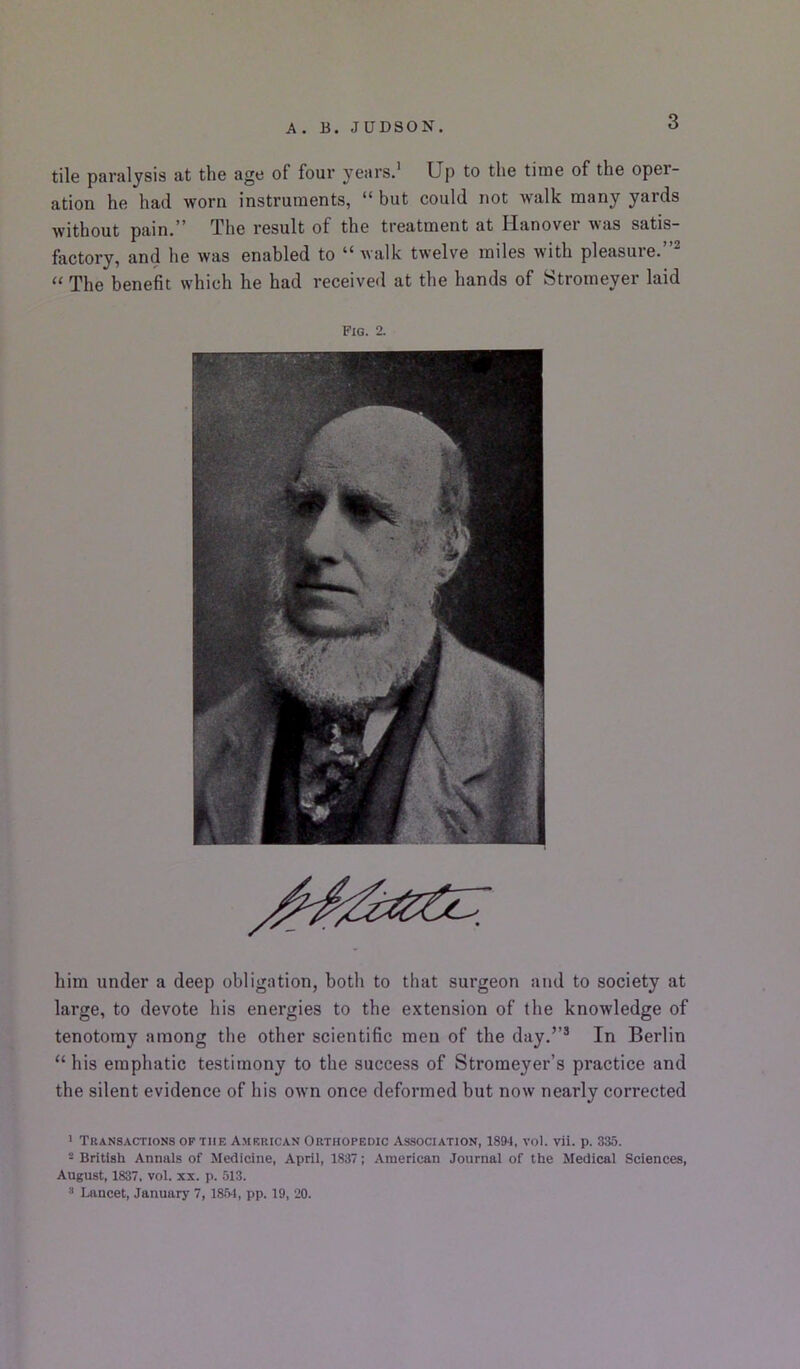 tile paralysis at the age of four years.' Up to the time of the oper- ation he had worn instruments, “ but could not walk many yards without pain.” The result of the treatment at Hanover was satis- factory, and he was enabled to walk twelve miles with pleasuie. “ The benefit which he had received at the hands of Stromeyer laid Fig. 2. him under a deep obligation, both to that surgeon and to society at large, to devote his energies to the extension of the knowledge of tenotomy among the other scientific men of the day.’’® In Berlin “his emphatic testimony to the success of Stromeyer’s practice and the silent evidence of his own once deformed but now nearly corrected * Transactions of the American Orthopedic Association, 1894, vol. vii. p. 335. 2 British Annals of Medicine, April, 1837; American Journal of the Medical Sciences, August, 1837. vol. XX. p. 513. ® lAincet, January 7, 1854, pp. 19, 20.