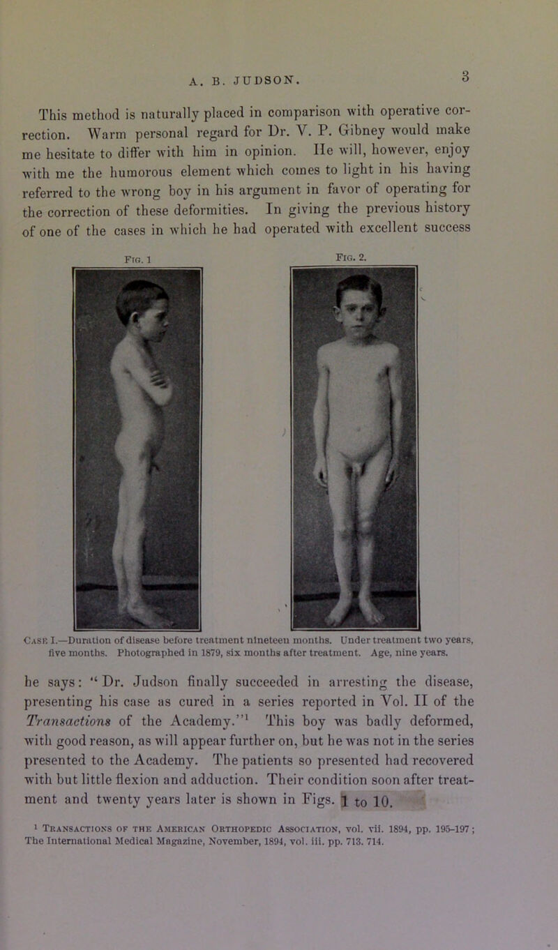 This method is naturally placed in comparison with operative cor- rection. Warm personal regard for Dr. V. P. Gibney would make me hesitate to differ with him in opinion. He will, however, enjoy with me the humorous element which comes to light in his having referred to the wrong boy in his argument in favor of operating for the correction of these deformities. In giving the previous history of one of the cases in which he had operated with excellent success Fig. 1 Fig. 2. Cask I.—Duration of disease before treatment nineteen months. Under treatment two years, five months. Photographed in 1879, six months after treatment. Age, nine years. he says: Dr. Judson finally succeeded in arresting the disease, presenting his case as cured in a series reported in Vol. II of the Transactions of the Academy.”* This boy was badly deformed, with good reason, as will appear further on, but he was not in the series presented to the Academy. The patients so presented had recovered with but little flexion and adduction. Their condition soon after treat- ment and twenty years later is shown in Figs. 1 to 10. 1 Transactions of the American Orthopedic Association, vol. vii. 1894, pp. 195-197; The International Medical Magazine, November, 1894, vol. iii. pp. 713. 714.