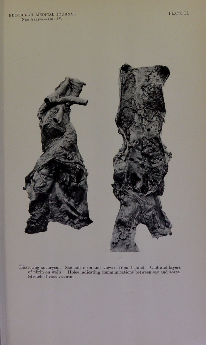 Xkw Sebie-s.—VOL. IV. Plate II. Dissecting aneurysm. Sac laid open and viewed from behind. Clot and layers of fibrin on walls. Holes indicating communications between sac and aorta. Stretched va.sa vasoruin.