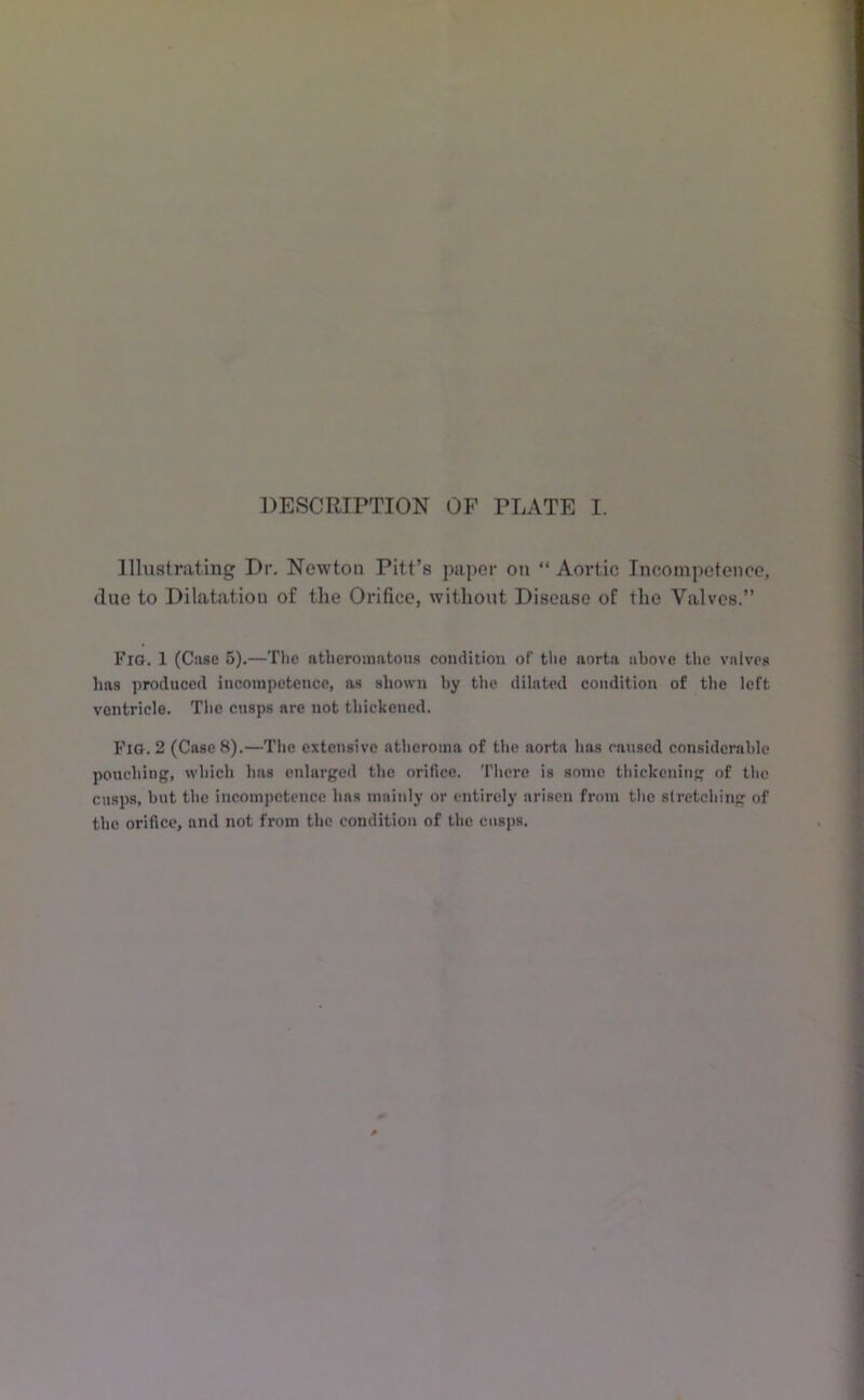 Illustriitiug Dr. Newton Pitt’s paper on “ Am’tic Incompetence, clue to Dilatation of the Orifice, without Disease of the Valves.” Fig. 1 (Case 5).—The atheromatous condition of the aorta above tlic valves has ])roduced incompetence, as shown hy the dilated condition of the left ventricle. The cusps are not thickened. Fig. 2 (Case 8).—The extensive atheroma of tlie aorta has caused considerable pouching, which has enlarged the orifice. There is some thickening of the cusps, but the incompetence has mainly or entirely arisen fntin tlio stretching of the orifice, and not from the condition of the cusps.