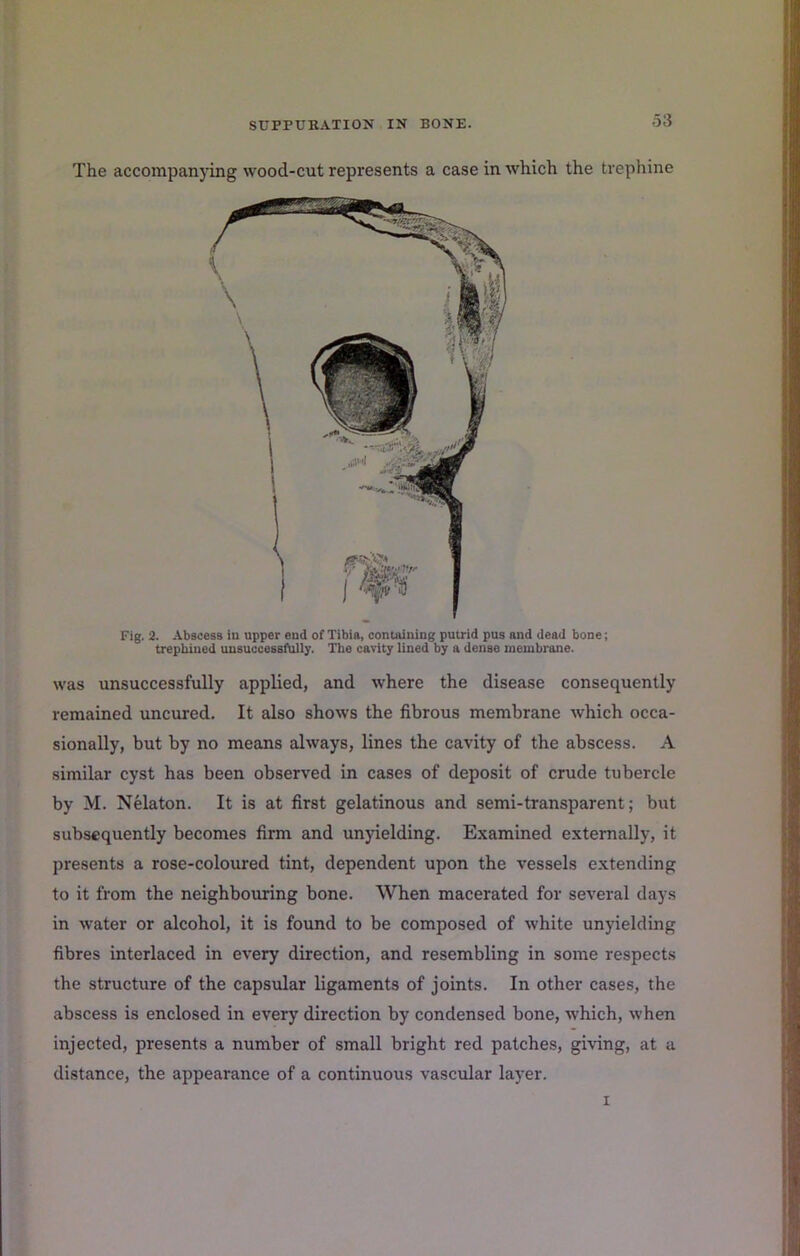 The accompanying wood-cut represents a case in which the trephine Fig. 2. Abscess in upper end of Tibia, containing putrid pus and dead bone; trephined unsuccessfully. The cavity lined by a dense membrane. was unsuccessfully applied, and where the disease consequently remained uncured. It also shows the fibrous membrane which occa- sionally, but by no means always, lines the cavity of the abscess. A similar cyst has been observed in cases of deposit of crude tubercle by M. Nelaton. It is at first gelatinous and semi-transparent; but subsequently becomes firm and unyielding. Examined externally, it presents a rose-coloured tint, dependent upon the vessels extending to it from the neighbouring bone. When macerated for several days in water or alcohol, it is found to be composed of white unyielding fibres interlaced in every direction, and resembling in some respects the structure of the capsular ligaments of joints. In other cases, the abscess is enclosed in every direction by condensed bone, which, when injected, presents a number of small bright red patches, giving, at a distance, the appearance of a continuous vascular layer. I