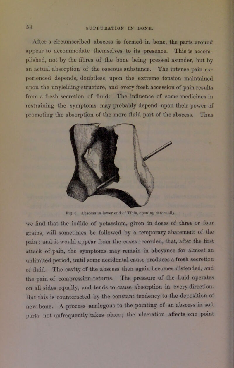 After a circumscribed abscess is formed in bone, the parts around appear to accommodate themselves to its presence. This is accom- jjlished, not by the fibres of the bone being pressed asunder, but by an actual absorption of the osseous substance. The intense pain ex- perienced depends, doubtless, upon the extreme tension maintained upon the unyielding structure, and every fresh accession of pain results from a fresh secretion of fluid. The influence of some medicines in restraining the symptoms may probably depend upon their power of promoting the absorption of the more fluid part of the abscess. Thus Fig. 3. Abscess in lower end of Tibia, opening exierually. we find that the iodide of potassium, given in doses of three or four grains, will sometimes be followed by a temporary abatement of the ])ain; and it would appear from the cases recorded, that, after the first attack of pain, the symptoms may remain in abeyance for almost an unlimited period, until some accidental cause produces a fresh secretion of fluid. The cavity of the abscess then again becomes distended, and the pain of compression returns. The pressure of the fluid operates on all sides equally, and tends to cause absorption in every direction. But this is counteracted by the constant tendency to the deposition of new bone. A process analogous to the pointing of an abscess in soft parts not unfrequently takes place; the ulceration affects one point