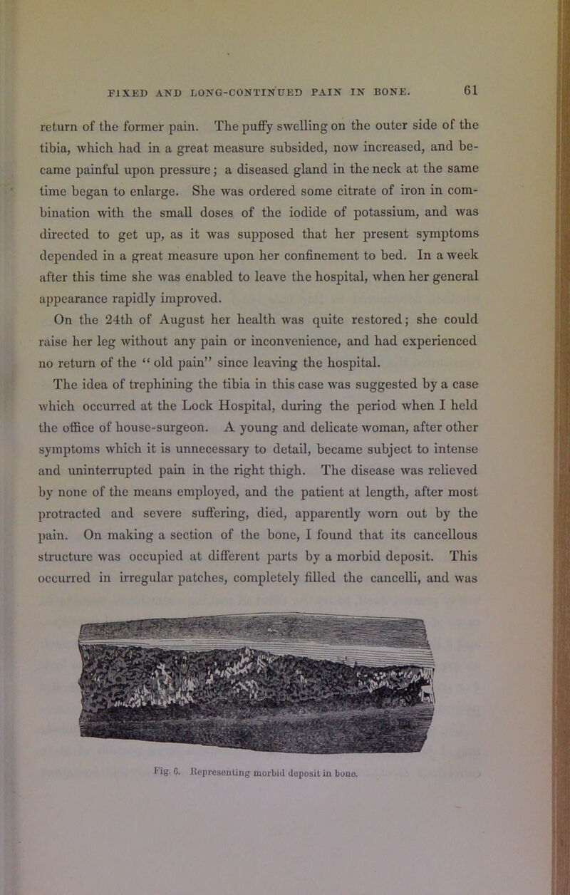 return of the former pain. The puflfy swelling on the outer side of the tibia, which had in a great measure subsided, now increased, and be- came painful upon pressure; a diseased gland in the neck at the same time began to enlarge. She was ordered some citrate of iron in com- bination with the small doses of the iodide of potassium, and was directed to get up, as it was supposed that her present symptoms depended in a great measure upon her confinement to bed. In a week after this time she was enabled to leave the hospital, when her general appearance rapidly improved. On the 24th of August her health was quite restored; she could raise her leg without any pain or inconvenience, and had experienced no return of the “ old pain” since leaving the hospital. The idea of trephining the tibia in this case was suggested by a case which occurred at the Lock Hospital, during the period when I held the office of house-surgeon. A young and delicate woman, after other symptoms which it is unnecessary to detail, became subject to intense and uninten-upted pain in the right thigh. The disease was relieved by none of the means employed, and the patient at length, after most protracted and severe suffering, died, apparently worn out by the pain. On making a section of the bone, I found that its cancellous structure was occupied at different parts by a morbid deposit. This occurred in irregular patches, completely filled the cancelli, and was rig. C. BeprcseuUiig morbid deposit iu boao.