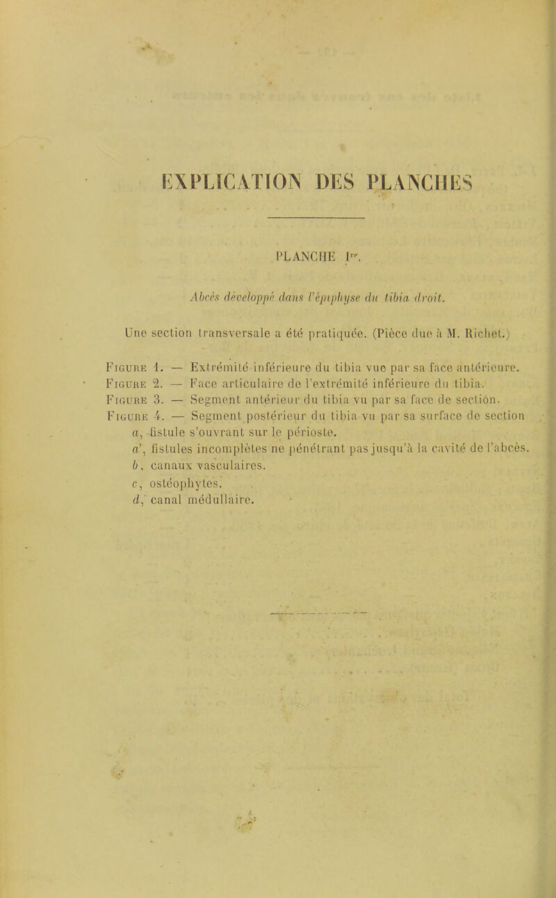 EXPLICATION DES PLANCHES PLANCHE I. Abcès développé dans l’épiphyse du tibia droit. Une section transversale a été pratiquée. (Pièce due à M. Richet.) Figure I. — Extrémité inférieure du tibia vue par sa face antérieure. Figure 2. — Face articulaire de l’extrémité inférieure du tibia. Figure 3. — Segment antérieur du tibia vu par sa face de section. Figure •'(•. — Segment postérieur du tibia vu par sa surface de section n, fistule s’ouvrant sur le périoste. a\ fistules incomplètes ne pénétrant pas jusqu’à la cavité de l’abcès. 6, canaux vasculaires. c, ostéophytes. d, ' canal médullaire.