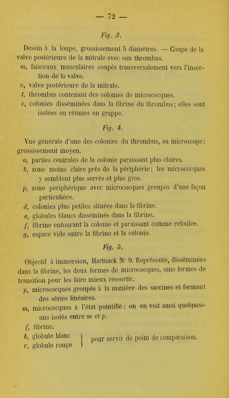 Dessin à la loupe, grossissement 5 diamètres. — Coupe de la valve postérieure de la mitrale avec son thrombus. m, faisceaux musculaires coupés transversalement vers l’inser- tion de la valve. v, valve postérieure de la mitrale. t, thrombus contenant des colonies de micrococques. c, colonies disséminées dans la fibrine du thrombus ; elles sont isolées ou réunies en grappe. Fig. 4. Yue générale d’une des colonies du thrombus, au microscope ; grossissement moyen. a, parties centrales de la colonie paraissant plus claires. b, zone moins claire près de la périphérie ; les micrococques y semblent plus serrés et plus gros. p, zone périphérique avec micrococques groupés d’une façon particulière. il, colonies plus petites situées dans la fibrine. e, globules blancs disséminés dans la fibrine. /, fibrine entourant la colonie et paraissant comme refoulée. g, espace vide entre la fibrine et la colonie. Fig. 5. Objectif à immersion, Hartnack Nc 9. Représente, disséminées dans la fibrine, les deux formes de micrococques, sans formes de transition pour les faire mieux ressortir. p, micrococques groupés à la manière des sarcines et formant des séries linéaires. m, micrococques à l’état pointillé ; on en voit aussi quelques- uns isolés entre m et p. fibrine. b, globule blanc j pour servir fie point de comparaison, r, globule rouge ) /