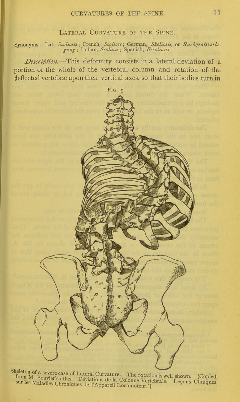 7'^ rolationiswdl shown. (CopI, Lateral Curvature of the Spine. Synonyms.—Lat. Scoliosis; French, Scoliose; German, Skoliosis, or Ruckgratsverbe- gung\ Italian, Scoliosi ■, Spanish, Escoliosis. Description.—This deformity consists in a lateral deviation of a portion or the whole of the vertebral column and rotation of the deflected vertebrae upon their vertical axes, so that their bodies turn in