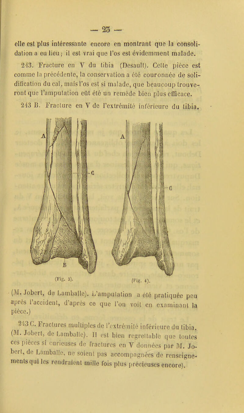 elle est plus intéressante encore en montrant que la consoli- dation a eu lieu ; il est vrai que l’os est évidemment malade. 2‘i3. Fracture en V du tibia (Desaullj. Celte pièce est comme la précédente, la conservation a été couronnée de soli- diOcation du cal, mais l’os est si malade, que beaucoup trouve- ront que 1 amputation eût etc Ü43 E. Fracture en V de (Fig. 3). jn remède bien plus efficace, ’extrémité inférieure du tibia. (Fig. 4). (iM. Jobcrt, do Lamballe). L’amputation a été pratiquée peu après 1 accident, d après ce que l’on voit en examinant la pièce.) - (j. Fractures multiples de rextrèmilé inférieure du tibia. (M. Jobert, de Lamballe). Il ost bien regrellablc que toutes ces pièces si curieuses de fractures en V données par M. Jo- bert, do Lamballe, ne soient pas accompagnées de renseigne- ments qui les rendraient mille fois plus précieuses encore).