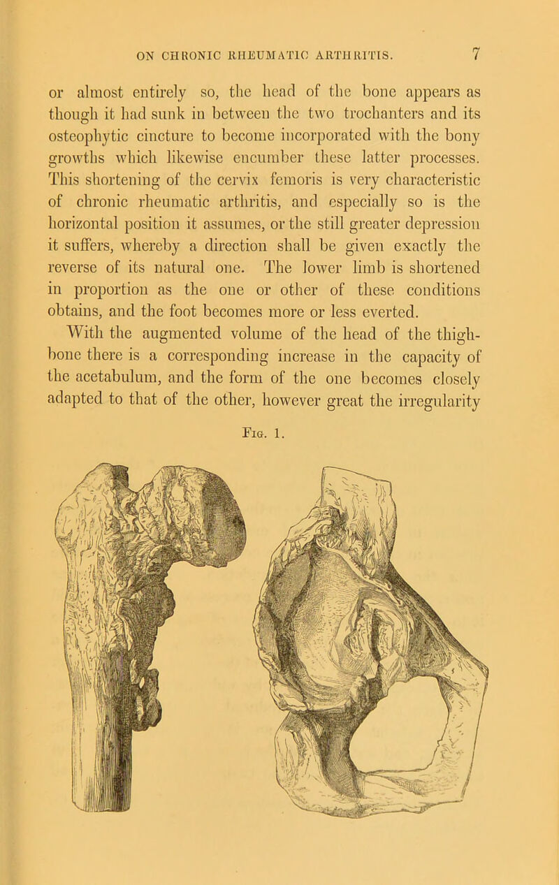 or almost entirely so, the head of the bone appears as though it had sunk in between the two trochanters and its osteophytic cincture to become incorporated with the bony growths which likewise encumber these latter processes. This shortening of the cervix femoris is very characteristic of chronic rheumatic arthritis, and especially so is the horizontal position it assumes, or the still greater depression it suffers, whereby a direction shall be given exactly the reverse of its natural one. The lower limb is shortened in proportion as the one or other of these conditions obtains, and the foot becomes more or less everted. With the augmented volume of the head of the thigh- bone there is a corresponding increase in the capacity of the acetabulum, and the form of the one becomes closely adapted to that of the other, however great the irregularity Fig. 1.