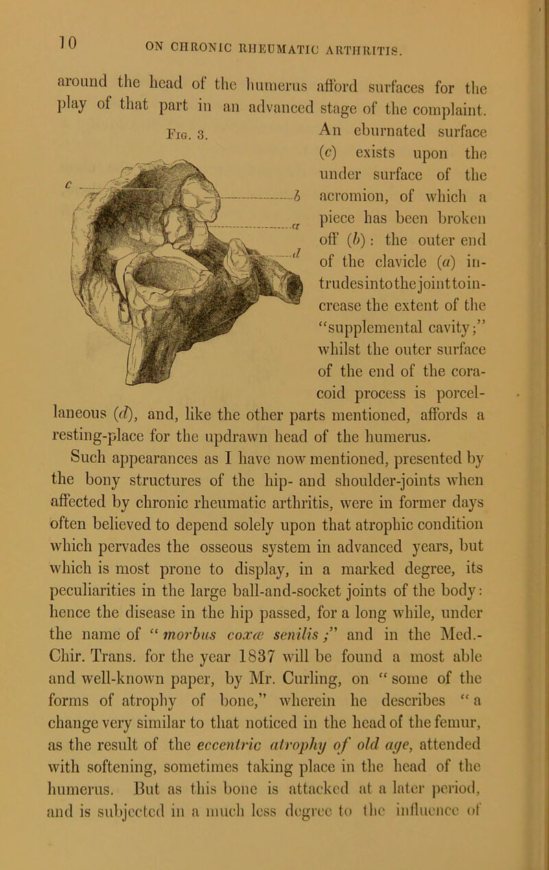 aiOLHid the head ot the Imniems aftbrd surfaces for tlie ])lay of that part in an advanced stage of the complaint. Fig. 3. An eliurnated surface (c) exists upon the under surface of the acromion, of whicli a piece has been broken off (h): the outer end of the clavicle (a) in- trudesin to the joint toin- crease the extent of the ‘‘supplemental cavity;” whilst the outer surface of the end of the cora- coid process is porcel- laneous ((1), and, like the other parts mentioned, affords a resting-place for the updrawn head of the humerus. Such appearances as I have now mentioned, presented by the bony structures of the hip- and shoulder-joints when affected by chronic rheumatic arthritis, were in former days often believed to depend solely upon that atrophio condition which pervades the osseous system in advanced years, but which is most prone to display, in a marked degree, its peculiarities in the large ball-and-socket joints of the body; hence the disease in the hip passed, for a long while, under the name of “ morbus coxce senilisand in the Med.- Chir. Trans, for the year 1837 will be found a most able and well-known paper, by Mr. Curling, on “ some of the forms of atrophy of bone,” wherein he describes “ a change very similar to that noticed in the head of the femur, as the result of the eccentric atrophy of old aye, attended with softening, sometimes taking place in the head of the humerus. But as this bone is attacked at a later period, and is subjected in a much less degree to the influence ol