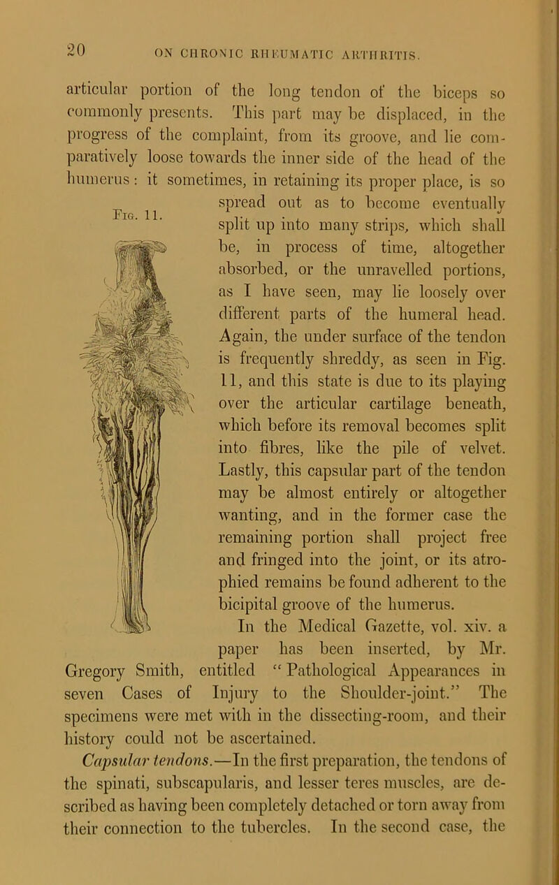 articulaT portion of the long tendon of the biceps so commonly presents. This part may be displaced, in the progress of the complaint, from its groove, and lie com- paratively loose towards the inner side of the head of the humerus ; it sometimes, in retaining its proper place, is so spread out as to become eventually split up into many strips, which shall be, in process of time, altogether absorbed, or the unravelled portions, as I have seen, may lie loosely over different parts of the humeral head. Again, the under surface of the tendon is frequently shreddy, as seen in Fig. 11, and this state is due to its playing over the articular cartilage beneath, which before its removal becomes split into fibres, like the pile of velvet. Lastly, this capsular part of the tendon may be almost entirely or altogether wanting, and in the former case the remaining portion shall project free and fringed into the joint, or its atro- phied remains be found adherent to the bicipital groove of the humerus. In the Medical Gazette, vol. xiv. a paper has been inserted, by Mr. Gregory Smith, entitled “ Pathological Appearances in seven Cases of Injury to the Shoulder-joint.” The specimens were met with in the dissecting-room, and their history could not be ascertained. Capsular tendons.—In the first preparation, the tendons of the spinati, subscapularis, and lesser teres muscles, are de- scribed as having been completely detached or torn away from their connection to the tubercles. In the second case, the Fig. 11.