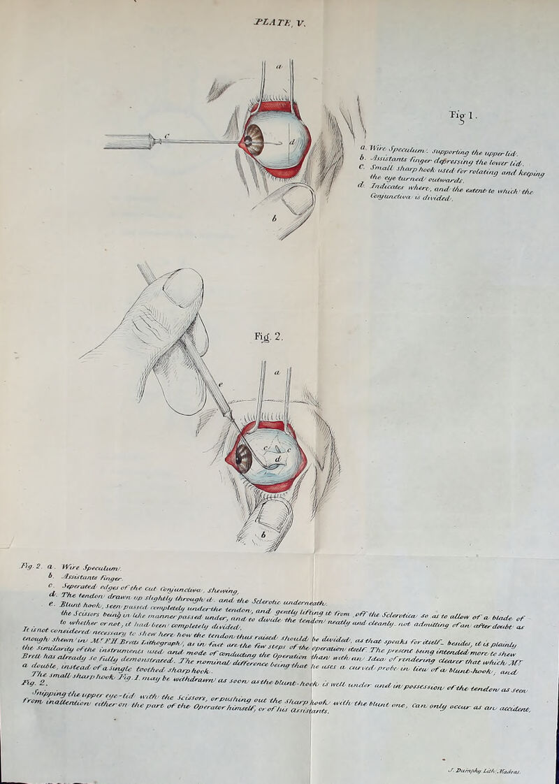 P'9- 2. a Wire Jpeeulam/. b. .Assistants finger. C. Mga cf tht cut a,njue,cUvu . sht.otho e. §8#* Uu™9“'* ScUrotu uudern^. ?“ S™m Sc';n,m f <- Me of to whether or nvt, it had, bun' completely dttkded <zc/y ueuicteanty .not admitting cron after douht at zzzzz tttszzz / “•—, a r^<*. ^ttad of a. tuu/u teethed-s/uirp hock. houses a. curoedetprohp in Ueue ofn thuit .hook „Zt '“ *“— —•- *««■ ~ — ....... mil neepuis ■ Small sharp hook used for relating , Mie eye turned/ outwards. and the C«w. to Much the CoryuncUva is divided/. ■S. Durnfihy Lit/o. Madras.