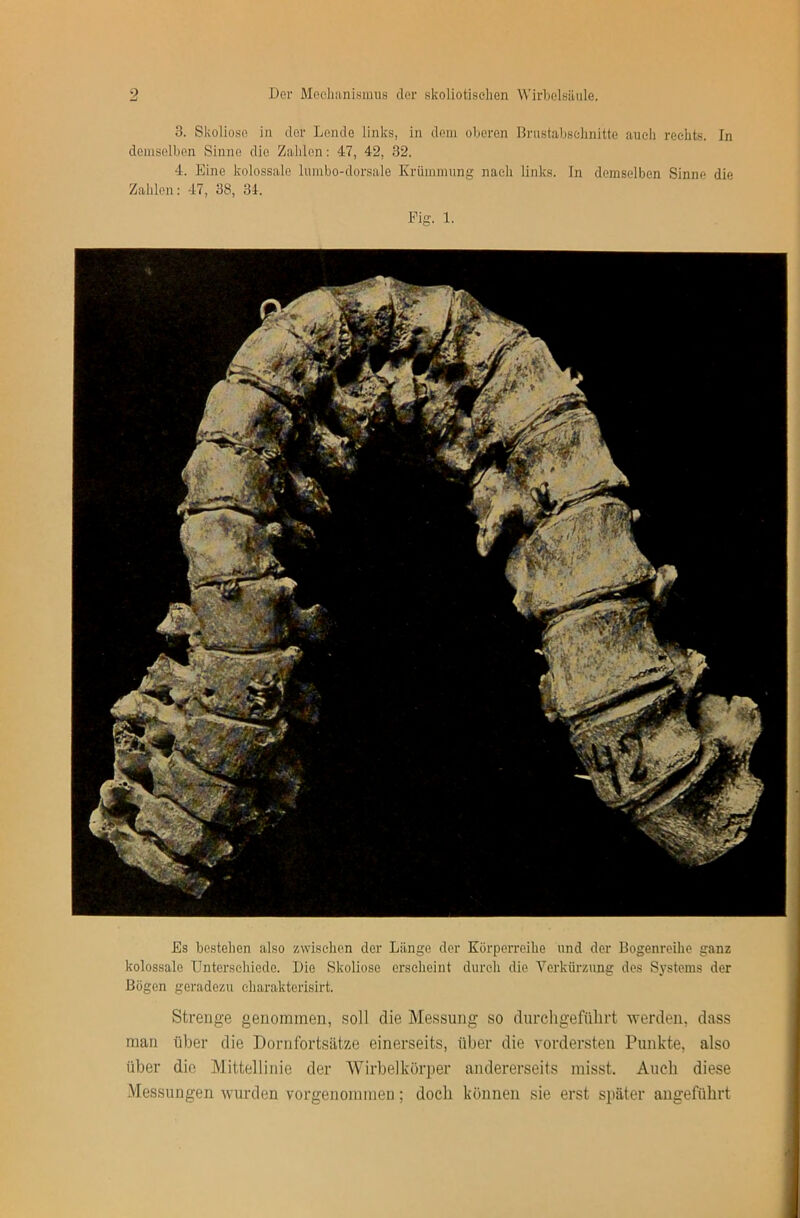 3. Skoliose in der Lende links, in dem oberen Brustabsehnitte aueli rechts. In demselben Sinne die Zalilen: 47, 42, 32. 4. Eine kolossale lumbo-dorsale Krümmung nach links. In demselben Sinne die Zahlen: 47, 38, 34. Fig. 1. Es bestehen also zwischen der Länge der Körperreihe und der Bogenreihe ganz kolossale Unterschiede. Die Skoliose erscheint durch die Verkürzung des Systems der Bögen geradezu eharakterisirt. Strenge genommen, soll die Messung so dnrchgefülirt werden, dass man über die Dornlbrtsätze einerseits, über die vordersten Punkte, also über die Mittellinie der Wirbelkörper andererseits misst. Auch diese Messungen wurden vorgenommen; doch können sie erst später angeführt