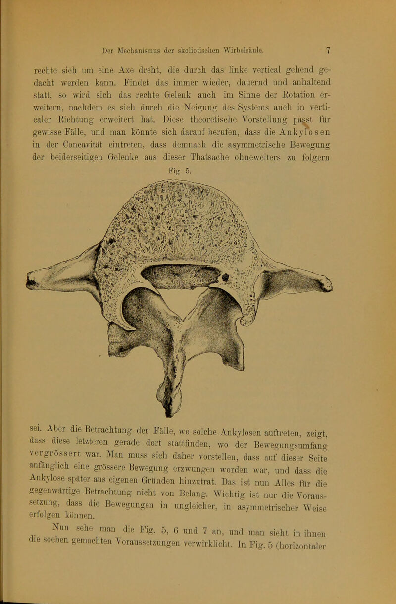 rechte sich um eine Axe dreht, die durch das liiike vertical gehend ge- dacht werden kann. Findet das immer wieder, dauernd und anhaltend statt, so wird sich das rechte Gelenk auch im Sinne der Eotation er- weitern, nachdem es sich durch die Neigung des S3'stems auch in verti- caler Eichtung erweitert hat. Diese theoretische Vorstellung pa^t für gewisse Fälle, und man könnte sich dar-auf berufen, dass die Ankylosen in der Concavität eintreten, dass demnach die asymmetrische Bewegung der beiderseitigen Gelenke aus dieser Thatsache ohiieweiters zu folgeru Fig. 5. sei. Abei die Betrachtung der Fälle, wo solche Ankylosen auftreten, zeigt, dass diese letzteren gerade dort stattfinden, wo der Bewegiingsumfang vergrössert war. Man muss sich daher vorstelleii, dass auf diier Seite anfänglich eine grossere Bewegung erzwungen worden war, und dass die Ankylose später aus eigenen Gründen hinzutrat. Das ist mm Alles für die gegenwärtige Betrachtung nicht von Belang. Wiclitig ist nur die Voraus- setzung, dass die Bewegungen in ungleicher, in asymmetrischer Weise erfolgen können. Nim sehe mail die ]?ig. 5. ß und 7 an, und man sielit in ihnen die soeben gemachten Voraussetzungen verwirklicht. Jn Fig. 5 (horizontaler