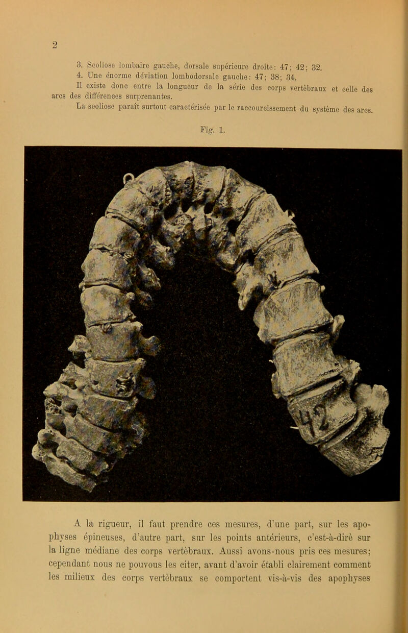 3. Scoliose lombaire gauche, dorsale supérieure droite: 47; 42; 32. 4. Une énorme déviation loinbodorsale gaueiie: 47; 38; 34. Il existe donc entre la longueur de la série dos corps vertébraux et celle des ares des différences surprenantes. La scoliose paraît surtout caractérisée par le raccourcissement du système des arcs. Fig. 1. A la rigueur, il faut prendre ces mesures, d’une part, sur les apo- physes épineuses, d’autre part, sur les points antérieurs, c’est-à-dirè sur la ligne médiane des corps vertébraux. Aussi avons-nous pris ces mesures; cependant nous ne pouvons les citer, avant d’avoir établi clairement comment les milieux des corps vertébraux se comportent vis-à-vis des apophyses