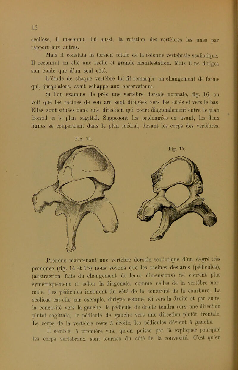 scoliose, il méconnu, lui aussi, la rotation des vertèbres les unes par rapport aux autres. Mais il constata la torsion totale de la colonne vertébrale scoliotique. Il reconnut en elle une réelle et grande manifestation. Mais il ne dirigea son étude que d’un seul côté. L’étude de chaque vertèbre lui fit remarqer un changement de forme qui, jusqu’alors, avait échappé aux observateurs. Si l’on examine de près une vertèbre dorsale normale, fig. 16, on voit que les racines de son are sont dirigées vers les côtés et vers le bas. Elles sont situées dans une direction qui court diagonalement entre le plan frontal et le plan sagittal. Supposent les prolongées en avant, les deux lignes se couperaient dans le plan médial, devant les corps des vertèbres. Fig. 14. Fig. 15. Prenons maintenant une vertèbre dorsale scoliotique d’un degré très prononcé (fig. 14 et 15) nous voyons que les racines des arcs (pédicules), (abstraction faite du changement de leurs dimensions) ne courent plus symétriquement ni selon la diagonale, comme celles de la vertèbre nor- male. Les pédicules inclinent du côté de la concavité de la courbure. La scoliose est-elle par exemple, dirigée comme ici vers la droite et par suite, la concavité vers la gauche, le pédicule de droite tendra vers une direction plutôt sagittale, le pédicule de gauche vers une direction plutôt frontale. Le corps de la vertèbre reste à droite, les pédicules dévient à gauche. Il semble, à première vue, qu’on puisse par là expliquer pourquoi les corps vertébraux sont tournés du côté de la convexité. C est qu en