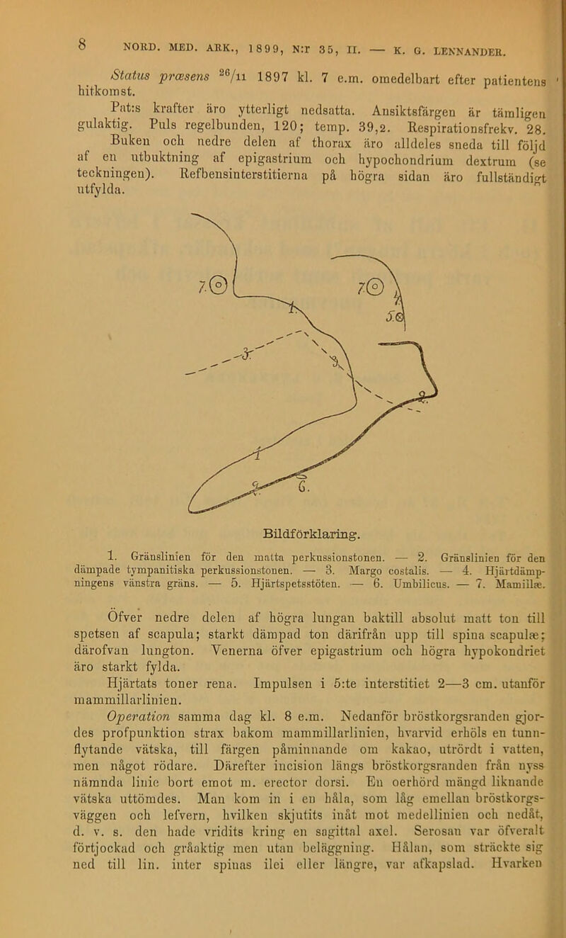Status prcBsens 1397 7 omedelbart efter patientens ' hitkomst. Pat;s krafter äro ytterligt nedsatta. Ansiktsfärgen är tämligen gulaktig. Puls regelbunden, 120; temp. 39,2. Respirationsfrekv. 28. Buken och nedre delen af thorax äro alldeles sneda till följd af en utbuktning af epigastrium och hypochondrium dextrum (se teckningen). Refbensinterstitierna på högra sidan äro fullständio-t utfylda. Bildförklaring. 1. Gränslinjen för den matta perknssionstonen. — 2. Gränslinien för den dämpade tympanitiska perknssionstonen. — 3. Margo costalis. — 4. Hjärtdämp- ningens vänstra gräns. — 5. Hjärtspetsstöten. — 6. Umbilicus. — 7. Mamillae. Öfver nedre delen af högra lungan baktill absolut matt ton till spetsen af scapula; starkt dämpad ton därifrån upp till spina scapulae; därofvan lungton. Venerna öfver epigastrium och högra hypokondriet äro starkt fylda. Hjärtats toner rena. Impulsen i 5:te interstitiet 2—3 cm. utanför mammillarlinien. Operation samma dag kl. 8 e.m. Nedanför bröstkorgsranden gjor- des profpunktion strax bakom mammillarlinien, hvarvid erhöls en tunn- flytande vätska, till färgen påminnande om kakao, utrördt i vatten, men något rödare. Därefter incision längs bröstkorgsranden från nyss nämnda linie bort emot m. erector dorsi. En oerhörd mängd liknande vätska uttömdes. Man kom in i en båla, soin låg emeUan bröstkorgs- väggen och lefvern, hvilken skjutits inåt mot medelliuien och nedåt, d. V. s. den hade vridits kring en sagittal axel. Serosau var öfveralt förtjockad och gråaktig men utan beläggning. Hålan, som sträckte sig ned till lin. inter spinas ilei eller längre, var afkapslad. Hvarken