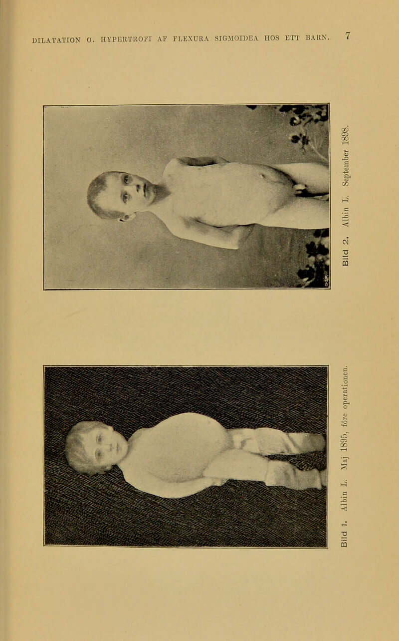 Bild 1. Albin L. Maj 189ö, före operationen. Bild 2. Albin L. September 1898.
