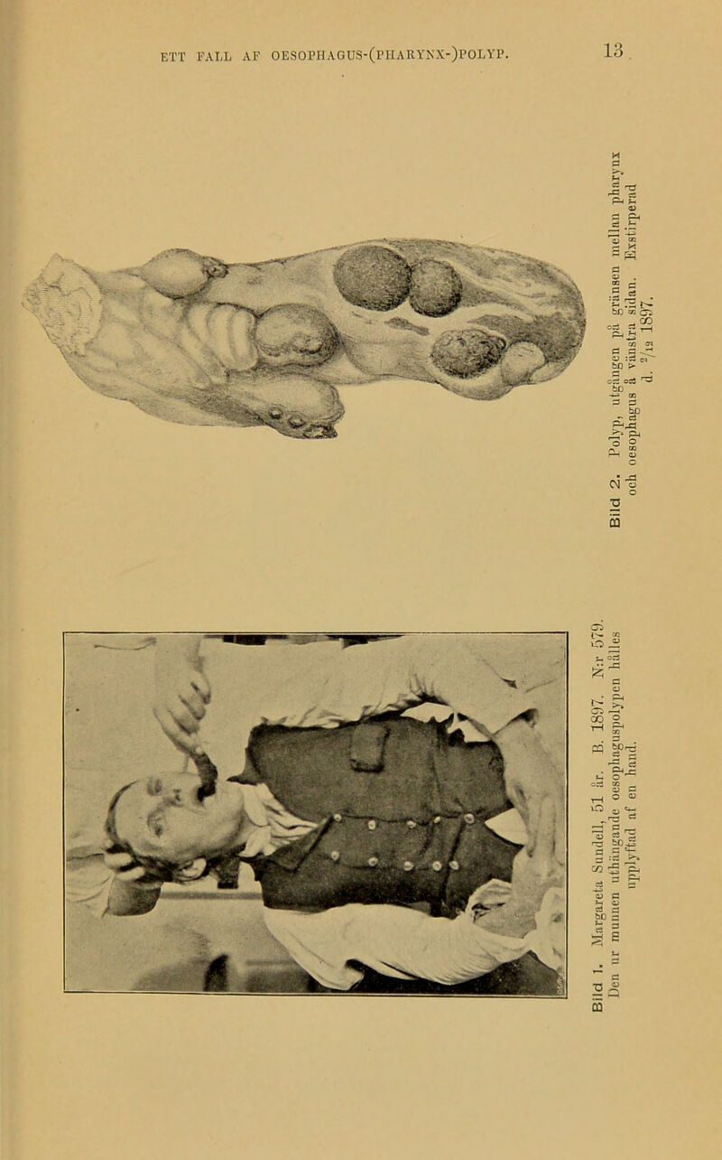 Bild 1. Margareta Sundell, 51 år. B. 1897. N:r 579. Den ur munnen uthängande oesophnguspolypen hålles Bild 2. Polyp, utgången på gränsen mellan phnrynx upplyftnd af en hand. och oesophagus å vänstra sidan. Exstirperad d. =/i2 1897.
