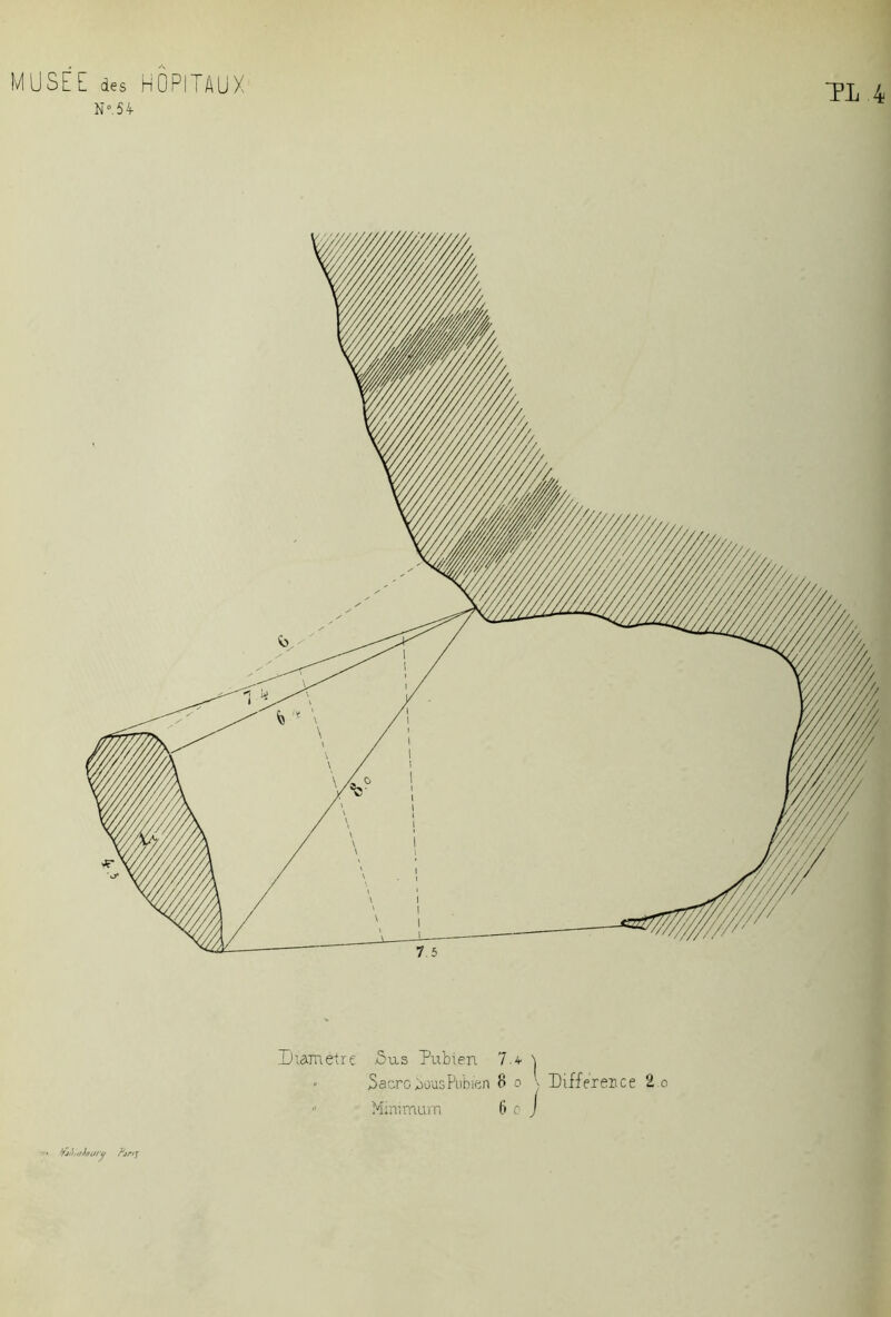 N° 54 Diamètre Sus Pubien 7> t « Sacre bous Pubien 8 o ■■ Différence 2 o ” Minimum 6 o J 7Jtï//7*oiHJ /'jnj