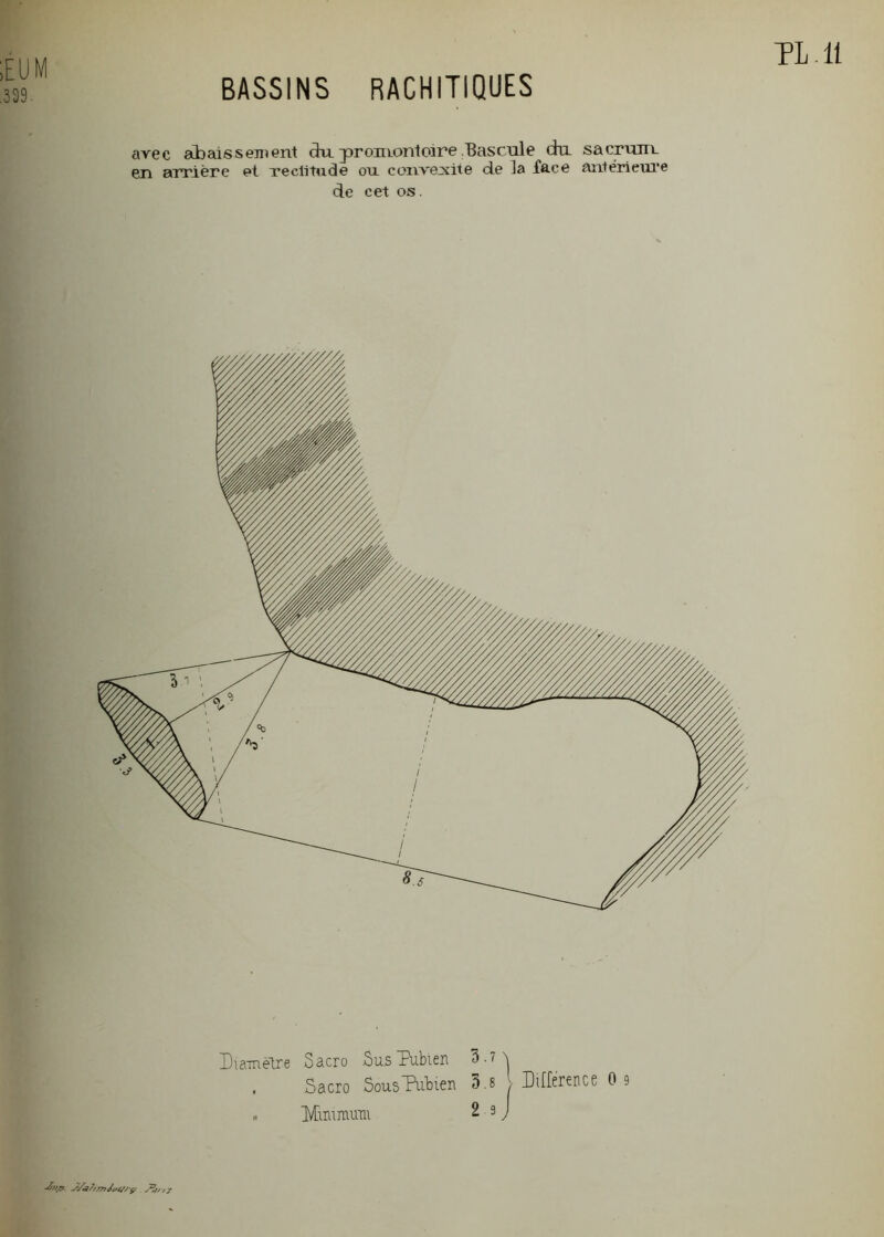 BASSINS RACHITIQUES EUM 339 avec abaissement du ^promontoire Bascule du sacrum. en arrière et rectitude ou convejsite de ]a face antérieure de cet os. Diamètre Sacro ÔusDubien 3.7 \ , Sacio Sous Pubien 3.8 > Différence 0 9 .. üÆimmuni 2 9 J