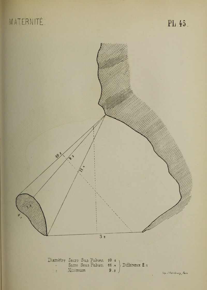 MATERNITE Diamètre Sacro Sas Pubien -J0 2 \  S&cro Sens Pubien M .4 Différence 2 a 11 .iC-iiimum 9.3 J Irnj). JMcdïnboufg trxj