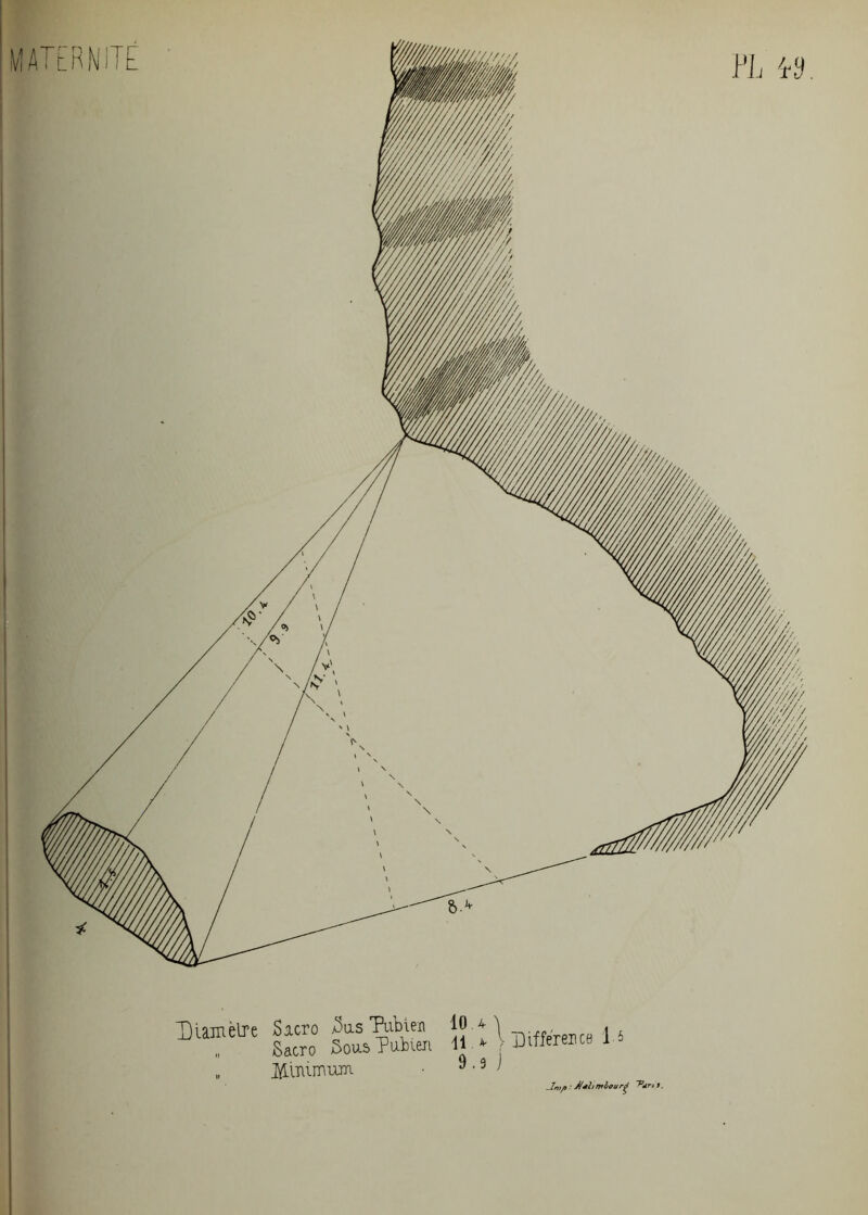 PL *9 Diamètre Sacro a)us Pubien „ Sacro Sous Pubien „ Minimum 10.* ï - , ii > V Différence 1.5 9.9 j _/rî;/o • Méhmlourg ^dri s.