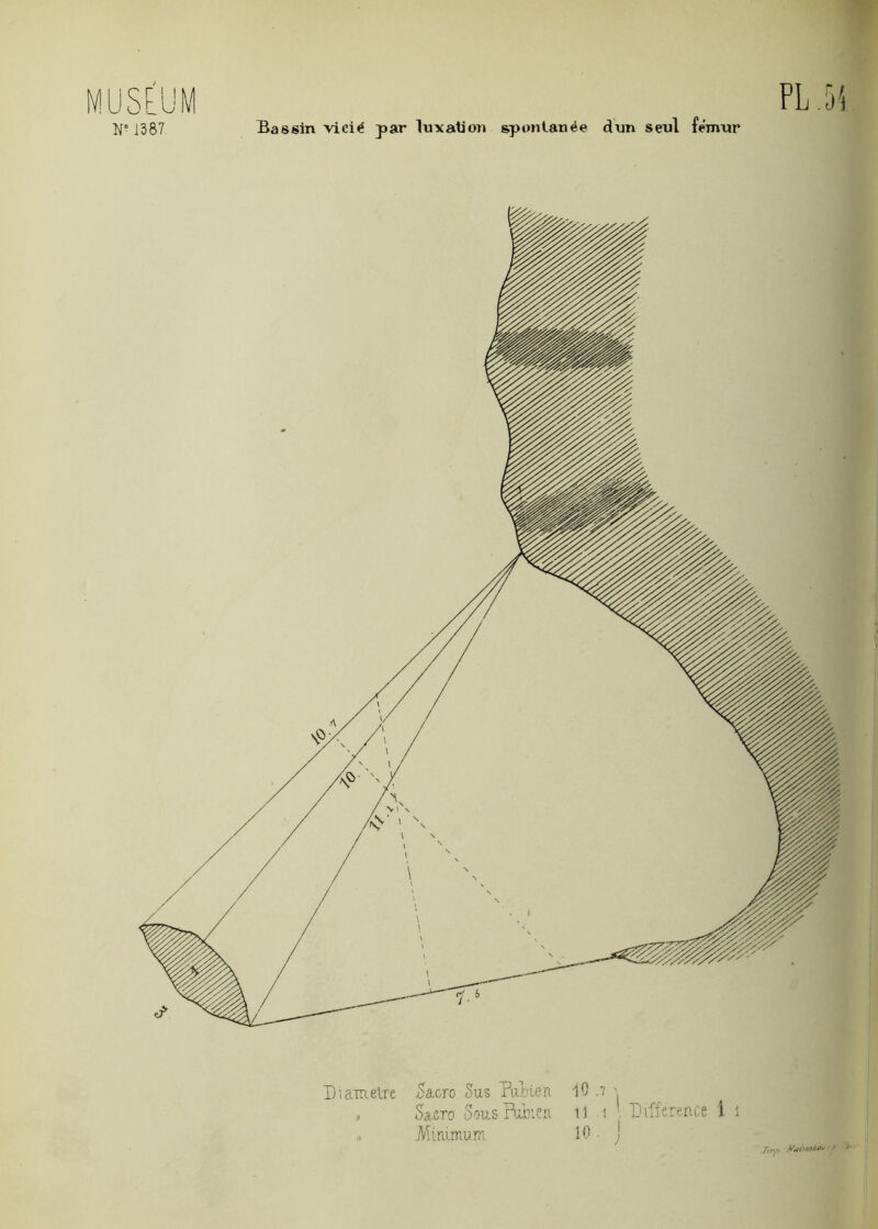 1387 Bassin vicié par luxation spontanée dun seul fémur PL Diamètre 5acro Sus Pallien , Sacro Sous Babiea „ Minimum il -i Différence 1 i 10. ! J,„p //ni'a’i-