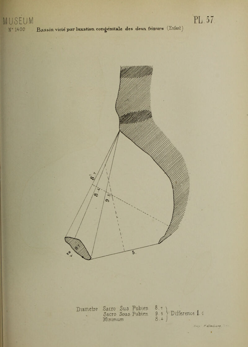 MUSEUM F 1400 Bassin vicié par luxation congénitale des deux fémurs (Enfant) PL 57 Diamelre Sacro Sus Pubien 8.7 1 ‘ ô&cro Sous Pubien 9.5 > Différence 1. A Minimum 8 . ^ j 7 ////» /*' V/ mJcU fa