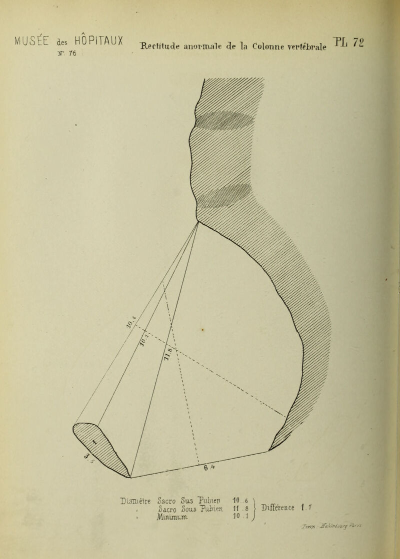 MUSÉE A des HOPITAUX Rectitude anormale delà Colonne vertébrale ^c JT. 76 Diamètre Sacro Sus Pubien 10 6 \ , Sacro Sous Pubien 11.8 Différence 1.7  Minunuiu 10 1 J Jrrtjo 3fdfcnéoi//y P^/’/'s