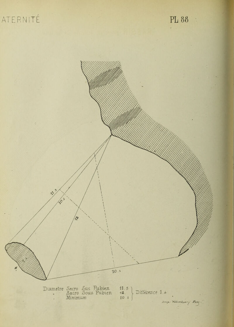 Diamelre 5a.cro /Su-S Pubien 11.5 ) „ 3acro Sous Pubien -12 I Différence , Mininuuri 1 o. e j : tfâh?T)iourJ JPirr'r