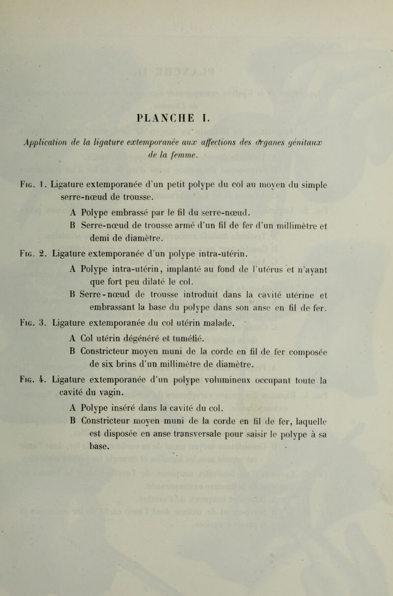 Application de la ligature extemporanée aux affections des (frganes génitaux de la femme. Fig. 1. Ligature extemporanée d’un petit polype du col au moyen du simple serre-nœud de trousse. A Polype embrassé par le fil du serre-nœud. B Serre-nœud de trousse armé d’un fil de fer d’un millimètre et demi de diamètre. Fig. 2. Ligature extemporanée d’un polype intra-utérin. A Polype intra-utérin, implanté au fond de l’utérus et n’ayant que fort peu dilaté le col. B Serre-nœud de trousse introduit dans la cavité utérine et embrassant la base du polype dans son anse en fil de fer. Fig. 3. Ligature extemporanée du col utérin malade. A Col utérin dégénéré et tuméfié. B Constricteur moyen muni de la corde en fil de fer composée de six brins d’un millimètre de diamètre. Fig. 4. Ligature extemporanée d’un polype volumineux occupant toute la cavité du vagin. A Polype inséré dans la cavité du col. B Constricteur moyen muni de la corde en fil de fer, laquelle est disposée en anse transversale pour saisir le polype à sa base.