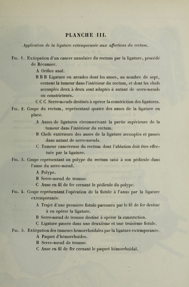 Application de la ligature extemporanée aux affections du rectum. Fig. 1. Extirpation d’un cancer annulaire du rectum par la ligature, procédé de Récamier. A Orifice anal. B B B Ligature en arcades dont les anses, au nombre de sept, cernent la tumeur dans l’intérieur du rectum, et dont les chefs accouplés deux à deux sont adaptés à autant de serre-nœuds ou constricteurs.. C C C Serre-nœuds destinés à opérer la constriction des ligatures. Fig. i. Coupe du rectum, représentant quatre des anses de la ligature en place. A Anses de ligatures circonscrivant la partie supérieure de la tumeur dans l’intérieur du rectum. B Chefs extérieurs des anses de la ligature accouplés et passés dans autant de serre-nœuds. C Tumeur cancéreuse du rectum dont l’ablation doit être effec- tuée par la ligature. Fig. 3. Coupe représentant un polype du rectum saisi à son pédicule dans l’anse du serre-nœud. A Polype. B Serre-nœud de trousse. C Anse en fil de fer cernant le pédicule du polype: Fig. i. Coupe représentant l’opération de la fistule à l’anus par la ligature extemporanée. A Trajet d’une première fistule parcouru par le fil de fer destiné à en opérer la ligature. B Serre-nœud de trousse destiné à opérer la constriction. C Ligature passée dans une deuxième et une troisième fistule. Fig. o. Flxtirpation des tumeurs hémorrhoïdales par la ligature extemporanée. A Paquet d’hémorrhoïdes. B Serre-nœud de trousse. C Anse en fil de fer cernant le paquet hémorrhoïdal.