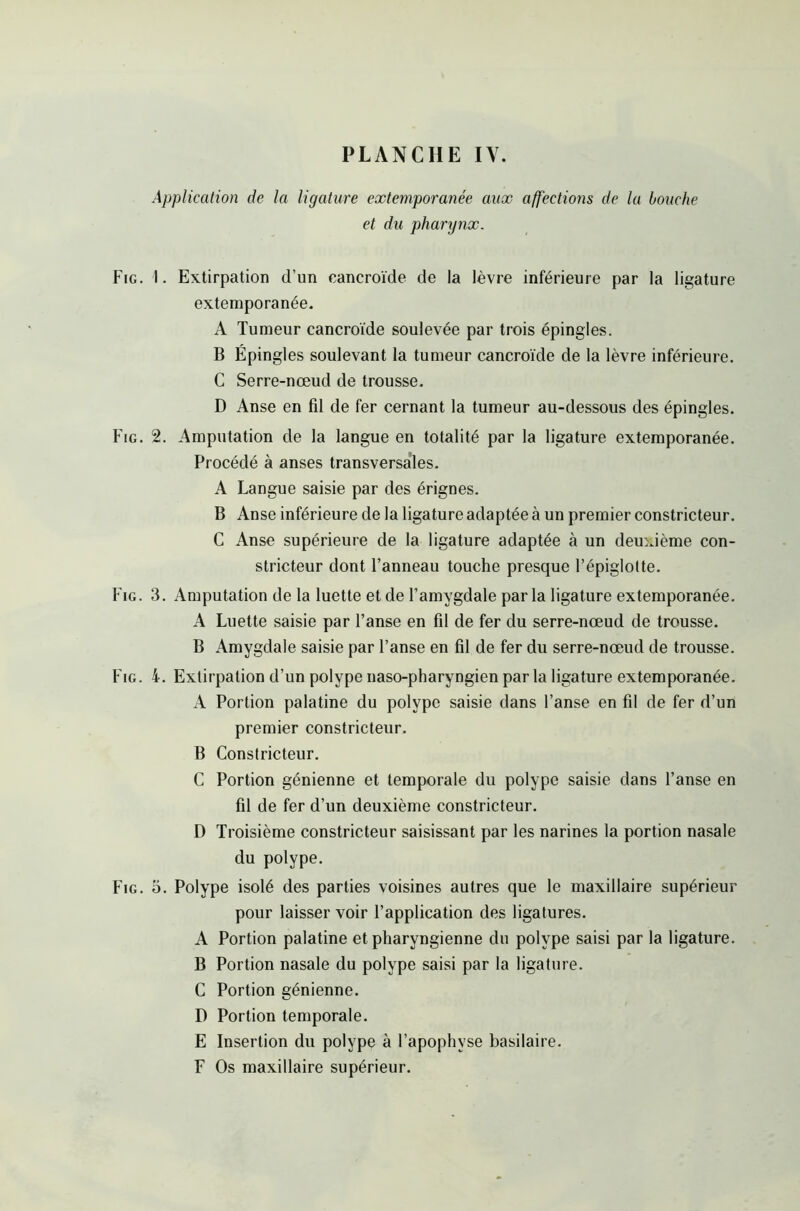 Application de la ligature extemporanée aux affections de la bouche et du pharynx. Fig. 1. Extirpation d’un cancroïde de la lèvre inférieure par la ligature extemporanée. A Tumeur cancroïde soulevée par trois épingles. B Épingles soulevant la tumeur cancroïde de la lèvre inférieure. C Serre-nœud de trousse. D Anse en fil de fer cernant la tumeur au-dessous des épingles. Fig. 2. Amputation de la langue en totalité par la ligature extemporanée. Procédé à anses transversales. A Langue saisie par des érignes. B Anse inférieure de la ligature adaptée à un premier constricteur. C Anse supérieure de la ligature adaptée à un deuxième con- stricteur dont l’anneau touche presque l’épiglotte. Fig. 3. Amputation de la luette et de l’amygdale parla ligature extemporanée. A Luette saisie par l’anse en fil de fer du serre-nœud de trousse. B Amygdale saisie par l’anse en fil de fer du serre-nœud de trousse. Fig. 4. Extirpation d’un polype naso-pharyngien parla ligature extemporanée. A Portion palatine du polype saisie dans l’anse en fil de fer d’un premier constricteur. B Constricteur. C Portion génienne et temporale du polype saisie dans l’anse en fil de fer d’un deuxième constricteur. D Troisième constricteur saisissant par les narines la portion nasale du polype. Fig. 5. Polype isolé des parties voisines autres que le maxillaire supérieur pour laisser voir l’application des ligatures. A Portion palatine et pharyngienne du polype saisi par la ligature. B Portion nasale du polype saisi par la ligature. C Portion génienne. D Portion temporale. E Insertion du polype à l’apophyse basilaire. F Os maxillaire supérieur.