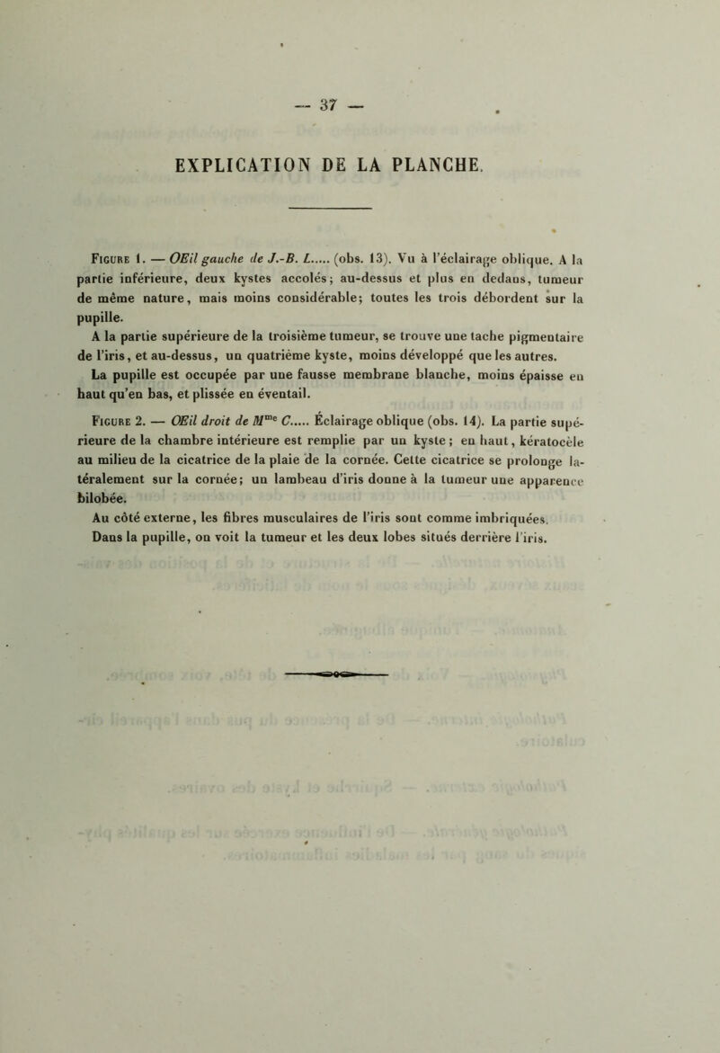 EXPLICATION DE LA PLANCHE. Figure 1. — OEil gauche de J.-B. L (obs. 13). Vu à l’éclairaj'e oblique. A la partie inférieure, deux kystes accolés; au-dessus et plus en dedans, tumeur de même nature, mais moins considérable; toutes les trois débordent sur la pupille. A la partie supérieure de la troisième tumeur, se trouve une tache pigmentaire de l’iris, et au-dessus, un quatrième kyste, moins développé que les autres. La pupille est occupée par une fausse membrane blanche, moins épaisse eu haut qu’en bas, et plissée en éventail. Figure 2. — OEil droit de C..... Eclairage oblique (obs. 14). La partie supé- rieure de la chambre intérieure est remplie par un kyste ; en haut, kératocèle au milieu de la cicatrice de la plaie ‘de la cornée. Cette cicatrice se prolonge la- téralement sur la cornée; un lambeau d’iris donne à la tumeur une apparence hilobée. Au côté externe, les fibres musculaires de l’iris sont comme imbriquées. Dans la pupille, on voit la tumeur et les deux lobes situés derrière l’iris. >«»