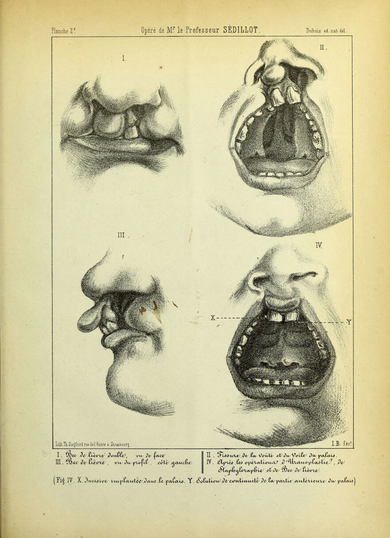 Planche Z ! Opéré de Mr le Professeur SÉDILLOT. Dubois id.nib.del. llÛi.TLSiejfrieiiuc M'Outre 4,5traj]iourj. I . » e-c de iVrvvc do lifte vu/ tV III. ^ &C , ywsdu y U) fiC , jtiK’a) /^vu^c&c II . /&*/ VlJtUlC/ Æl)i)M/Vcl^ i)U/ . IV. fSby\<L6 ^ ;^\XrUX^O^CcU>ti^Ly J fîoJ StixpivvyCoUxyloicJ jdCfiv $be& jdcJ Zvbp^c^J.