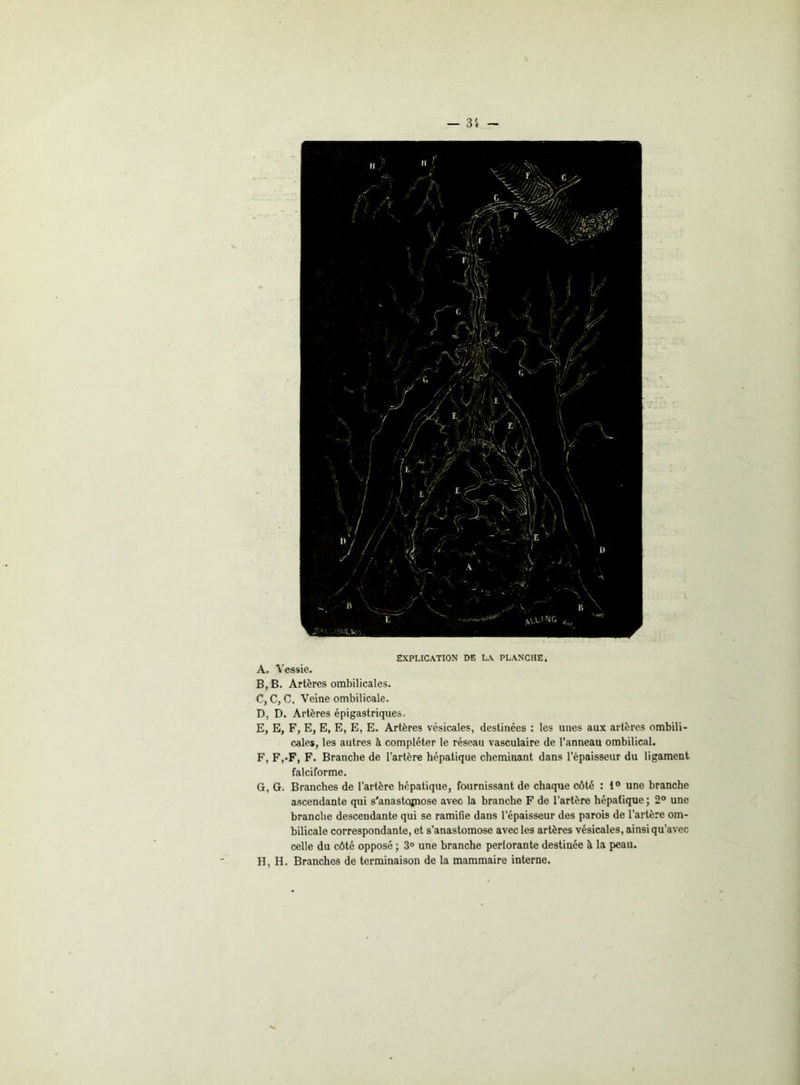 EXPLICATION DE LA PLANCHE. A, Vessie. B, B. Artères ombilicales. C, C, C. Veine ombilicale. D, D. Artères épigastriques. E, E, F, E, E, E, E, E. Artères vésicales, destinées : les unes aux artères ombili- cales, les autres h compléter le réseau vasculaire de l’anneau ombilical. F, F,-F, F. Branche de l’artère hépatique cheminant dans l’épaisseur du ligament falciforme. G, G. Branches de l’artère hépatique, fournissant de chaque côté : 1° une branche ascendante qui s'anastqjnose avec la branche F de l’artère hépatique ; 2° une branche descendante qui se ramifie dans l’épaisseur des parois de l’artère om- bilicale correspondante, et s’anastomose avec les artères vésicales, ainsi qu’avec celle du côté opposé ; 3° une branche perforante destinée à la peau. H, H. Branches de terminaison de la mammaire interne.