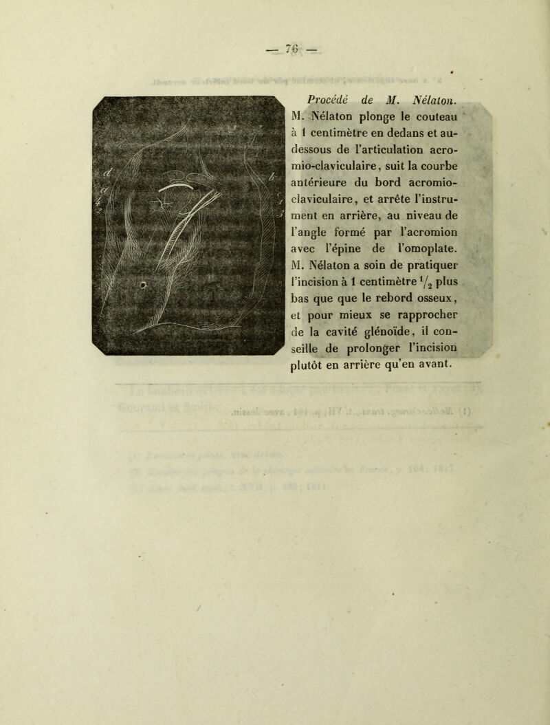 Procédé de M. N étalon. M. Nélaton plonge le couteau à 1 centimètre en dedans et au- dessous de l’articulation acro- mio-claviculaire, suit la courbe antérieure du bord acromio- claviculaire, et arrête l’instru- ment en arrière, au niveau de l’angle formé par l’acromion avec l’épine de l’omoplate. M. rS'élaton a soin de pratiquer l’incision à 1 centimètre Y2 plus bas que que le rebord osseux, et pour mieux se rapprocher de la cavité glénoïde, il con- seille de prolonger l’incision plutôt en arrière qu’en avant.