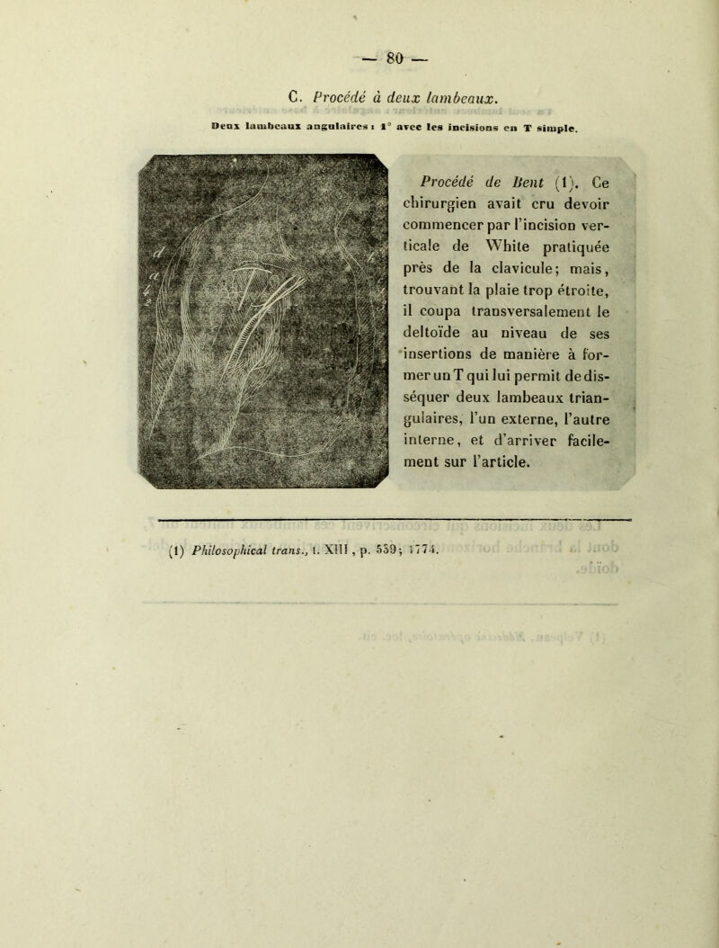 C. Procédé à deux lambeaux. Deux lambeaux angulaires i 1“ arec les incisions en T simple. Procédé de lient (1). Ce chirurgien avait cru devoir commencer par l’incision ver- ticale de White pratiquée près de la clavicule; mais, trouvant la plaie trop étroite, il coupa transversalement le deltoïde au niveau de ses insertions de manière à for- mer unT qui lui permit dedis- séquer deux lambeaux trian- gulaires, l’un externe, l’autre interne, et d’arriver facile- ment sur l’article.