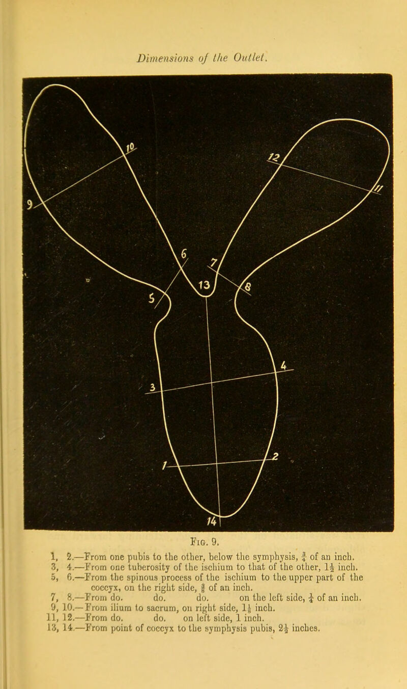 Fig. 9. 1, 2.—From one pubis to the other, below the symphysis, j of an inch. 3, 4.—From one tuberosity of the ischium to that of the other, 1\ inch. 5, 6.—From the spinous process of the ischium to the upper part of the coccyx, on the right side, g of an inch. 7, 8.—From do. do. do. on the left side, of an inch. 9, 10.— From ilium to sacrum, on right side, 1| inch. 11, 12.—From do. do. on left side, 1 inch.