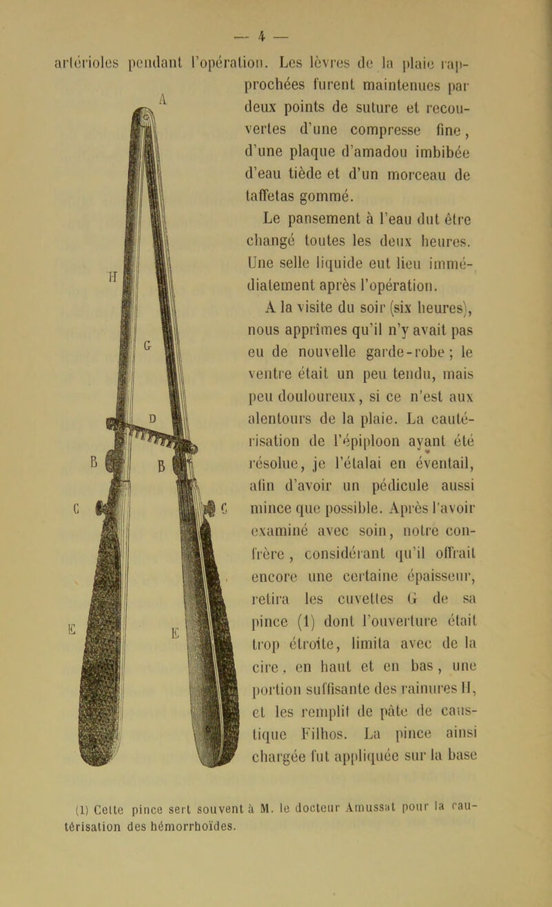 aricriolcs pcMulaul l’opéra lion. Les lèvres de la |>laie rap- prochées furent maintenues par deux points de suture et recou- vertes d’une compresse fine, d’une plaque d’amadou imbibée d’eau tiède et d’un morceau de taffetas gommé. Le pansement à l’eau dut être changé toutes les deux heures. Une selle liquide eut lieu immé- diatement après l’opération. A la visite du soir (six heures), nous apprîmes qu’il n’y avait pas eu de nouvelle garde-robe; le ventre était un peu tendu, mais peu douloureux, si ce n’est aux alentours de la plaie. La caulé- l'isation de l’épiploon ayant été l'ésoluc, je l’étalai en éventail, alin d’avoir un pédicule aussi mince que possible. Après l’avoir examiné avec soin, notre con- frère , considérant ({u’il olfrail encore une certaine épaisseur, letira les cuvettes G de sa pince (1) dont rouverlure était trop étroite, limita avec de la cire, en haut et en bas , une portion sulTisantc des rainures II, et les l’enqdit de pâte de caus- tique Filhos. La pince ainsi chai'gée fut ap[>li(piée sur la base (1) Celte pince sert souvent à M. le docteur .\mussnt pour la cau- térisation des héniorrhoïdes.